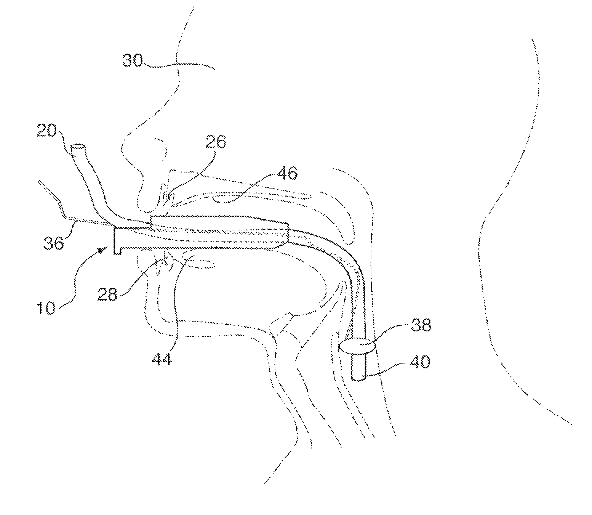 Endotracheal tube protector