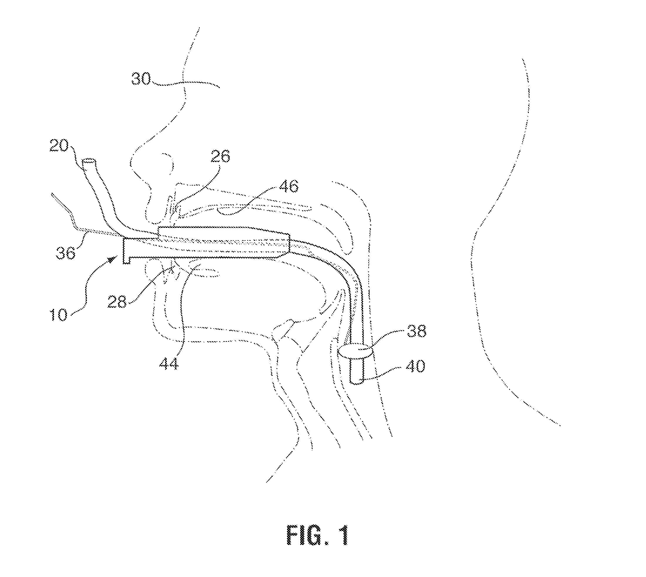 Endotracheal tube protector