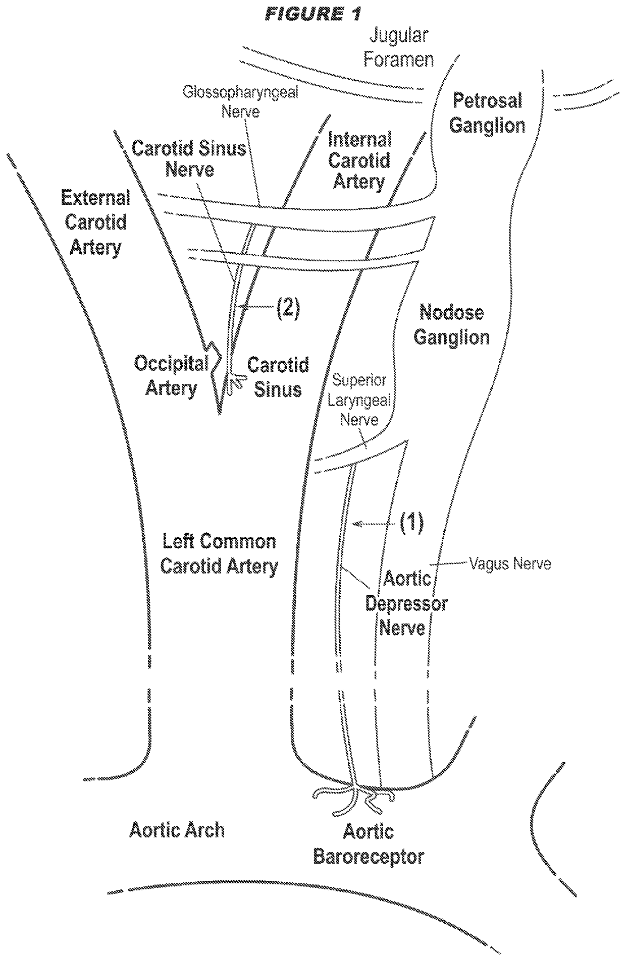 Neuromodulation of baroreceptor reflex