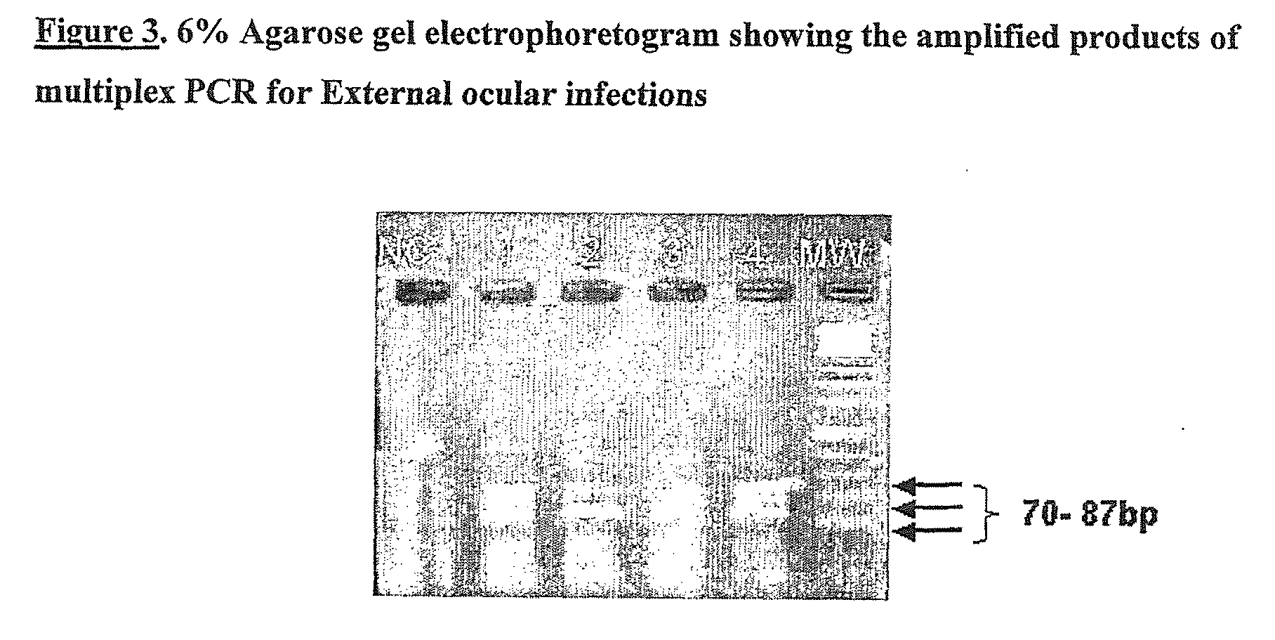 Novel method for simultaneous detection and discrimination of bacterial, fungal, parasitic and viral infections of eye and central nervous system