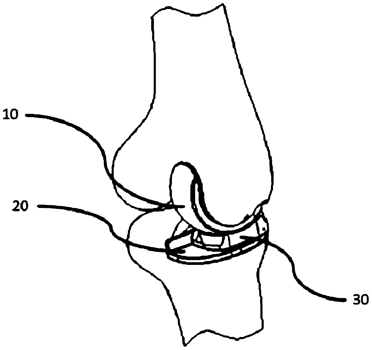 Single-compartment knee joint prosthesis and manufacturing method thereof