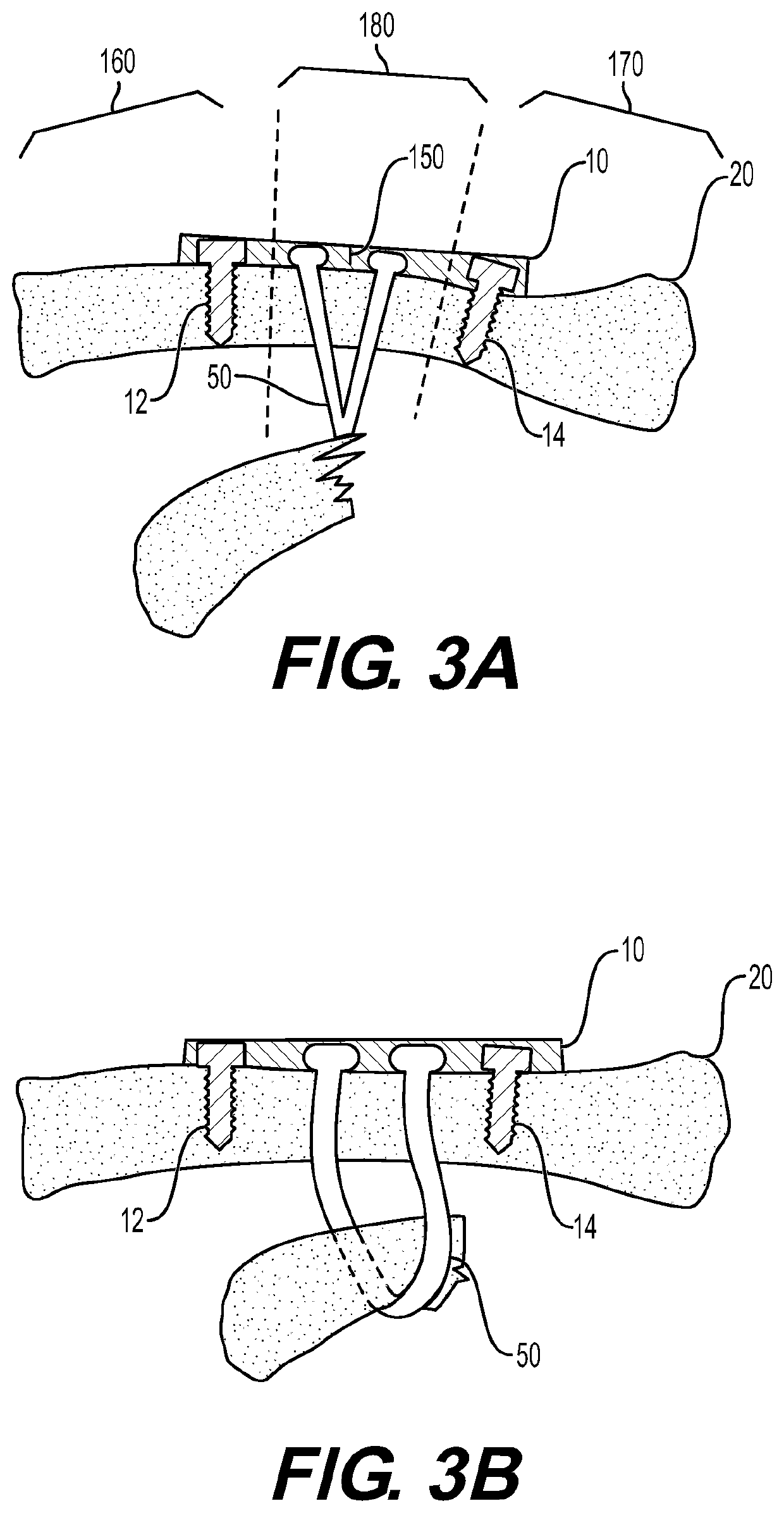 Device for and method of treating acromioclavicular joint dislocations