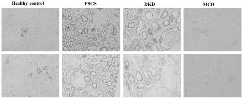 Application of retinoic acid receptor reactive protein 1 as biomarker in chronic kidney disease