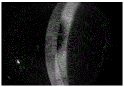 Application of cornea surface protection agent in general anaesthesia operations