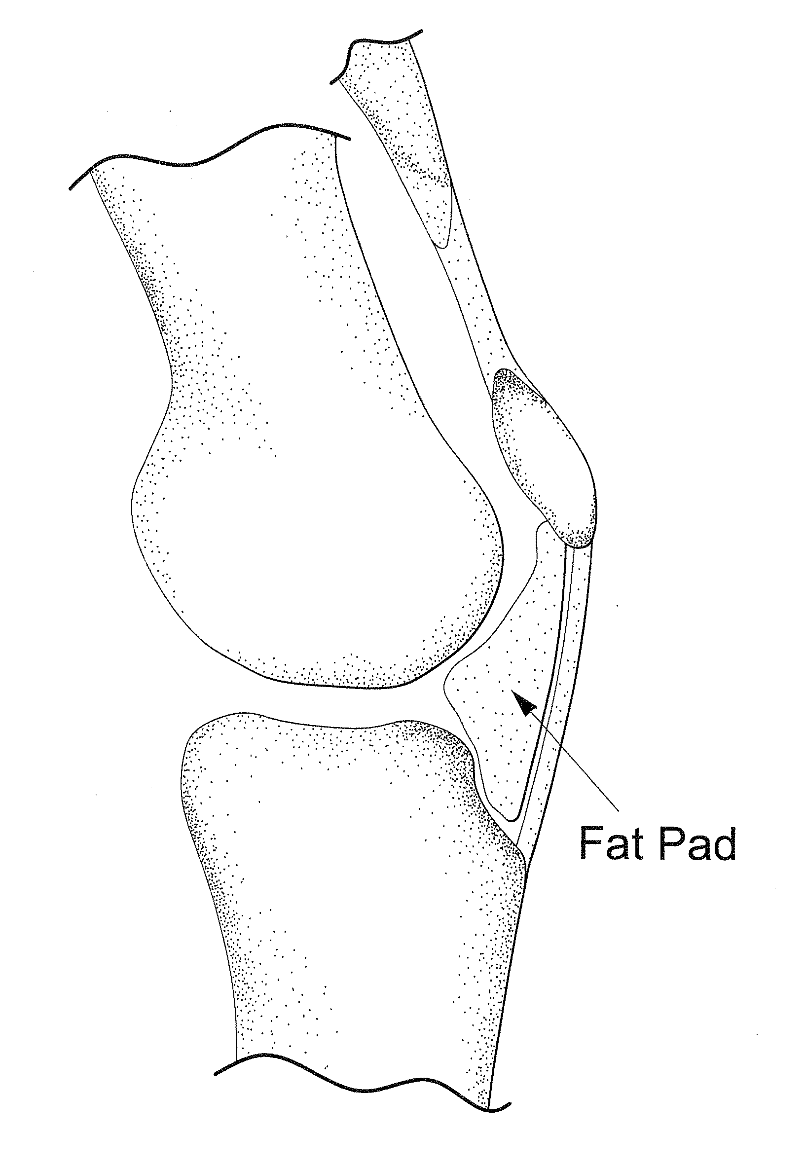 Method for improving cartilage repair and/or preventing cartilage degeneration in a joint