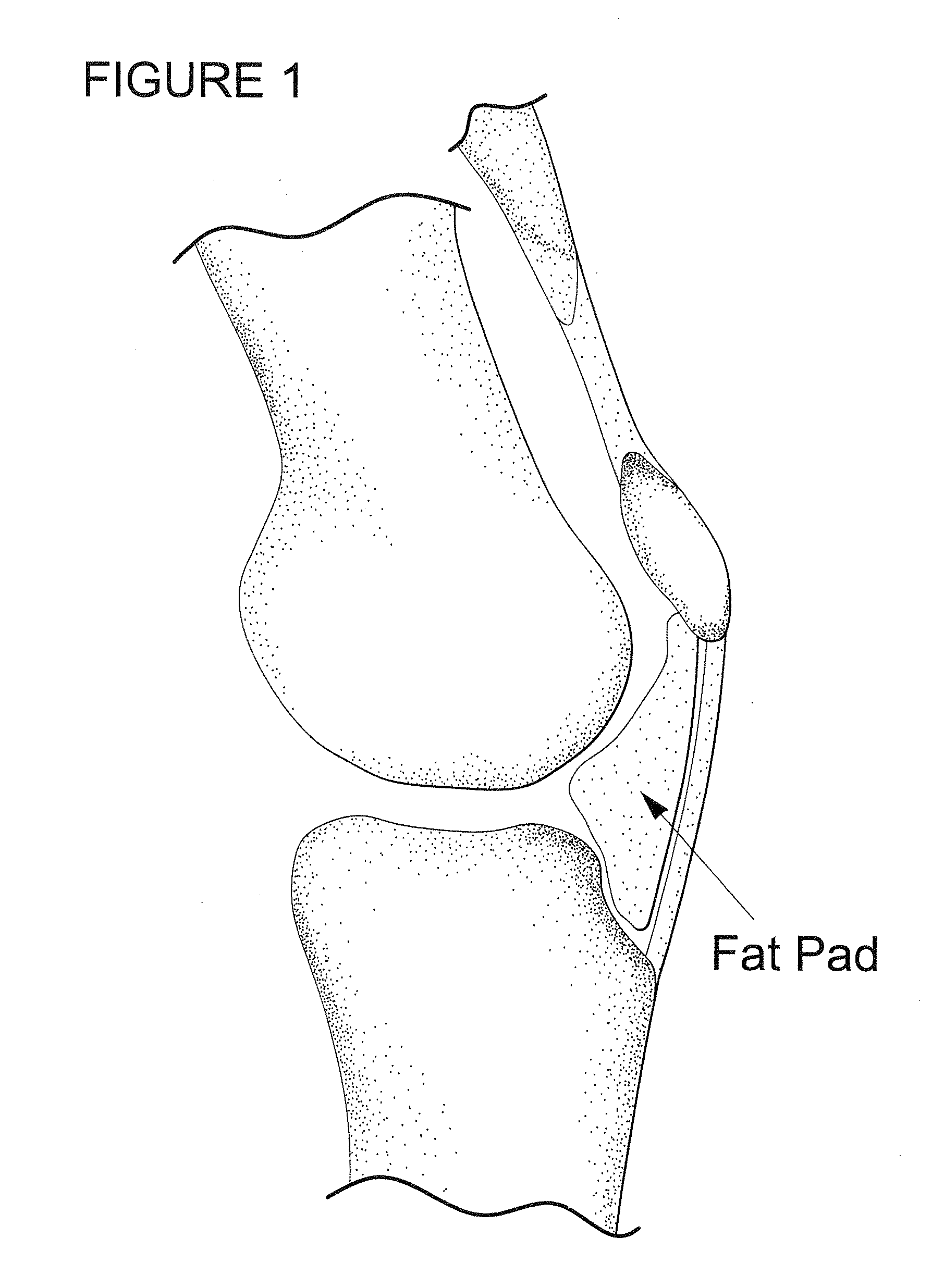 Method for improving cartilage repair and/or preventing cartilage degeneration in a joint