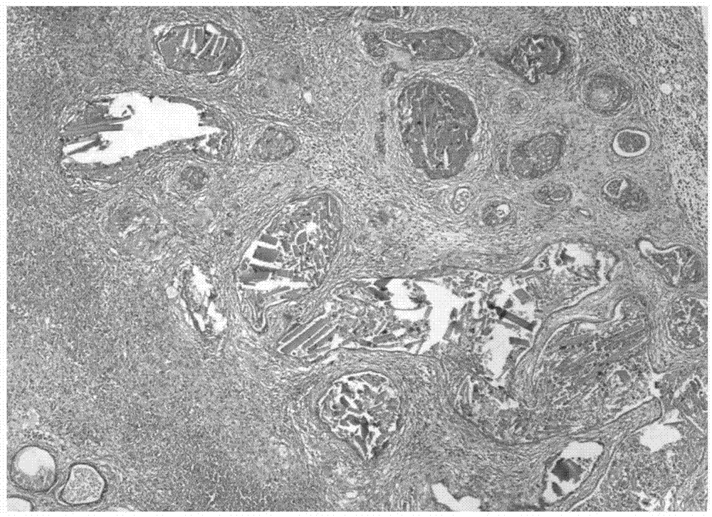 Traditional Chinese medicine composition used for treating prostatitis or benign prostatic hyperplasia