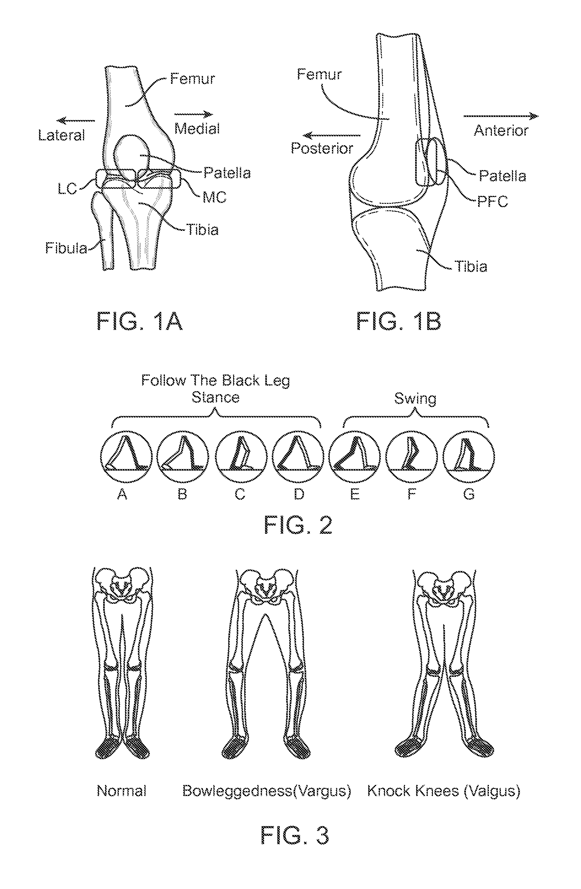 Method and Apparatus for Altering Biomechanics of the Articular Joints