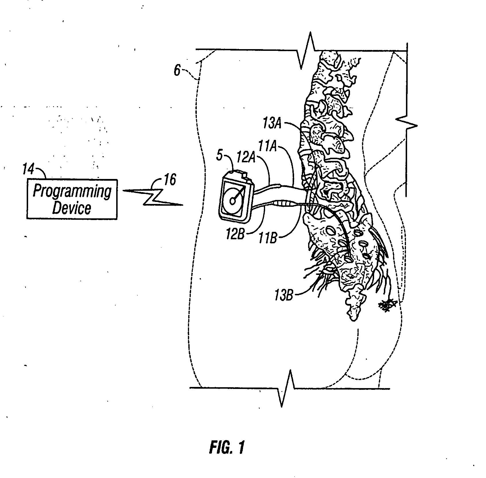 Human-implantable-neurostimulator user interface having multiple levels of abstraction