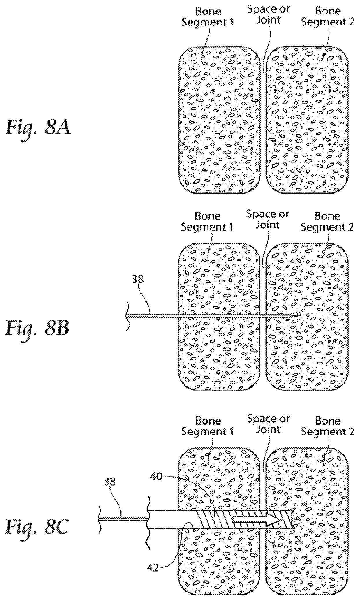 Apparatus, systems, and methods for the fixation or fusion of bone