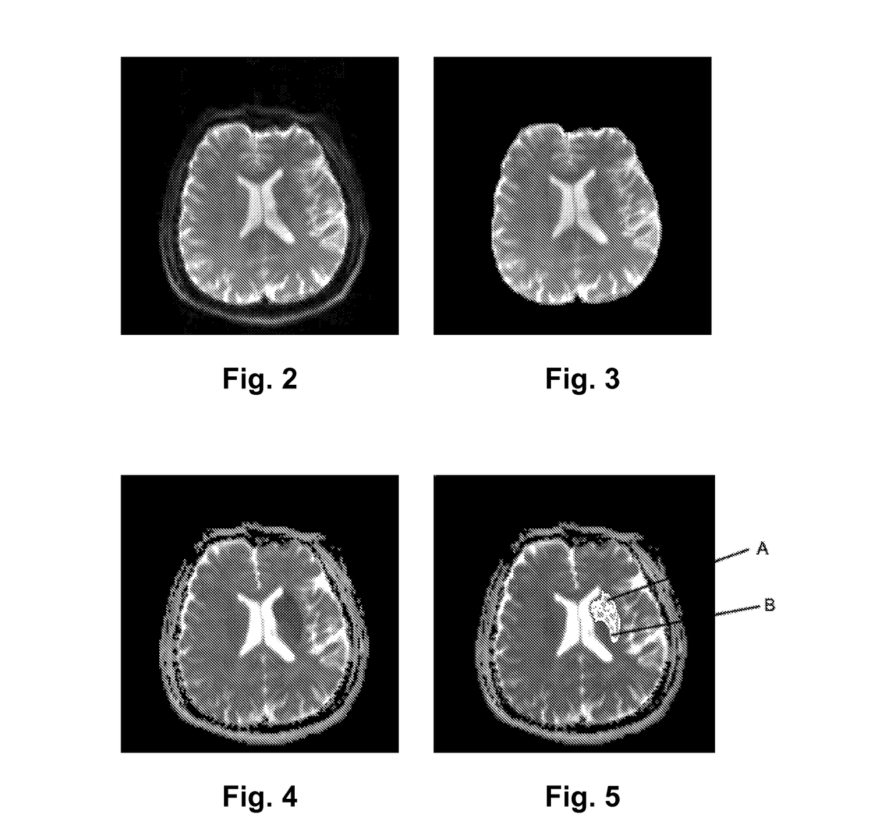 Methods and devices for producing the parameters of the brain tissues and assessing data of the suitability for thrombolysis of a patient