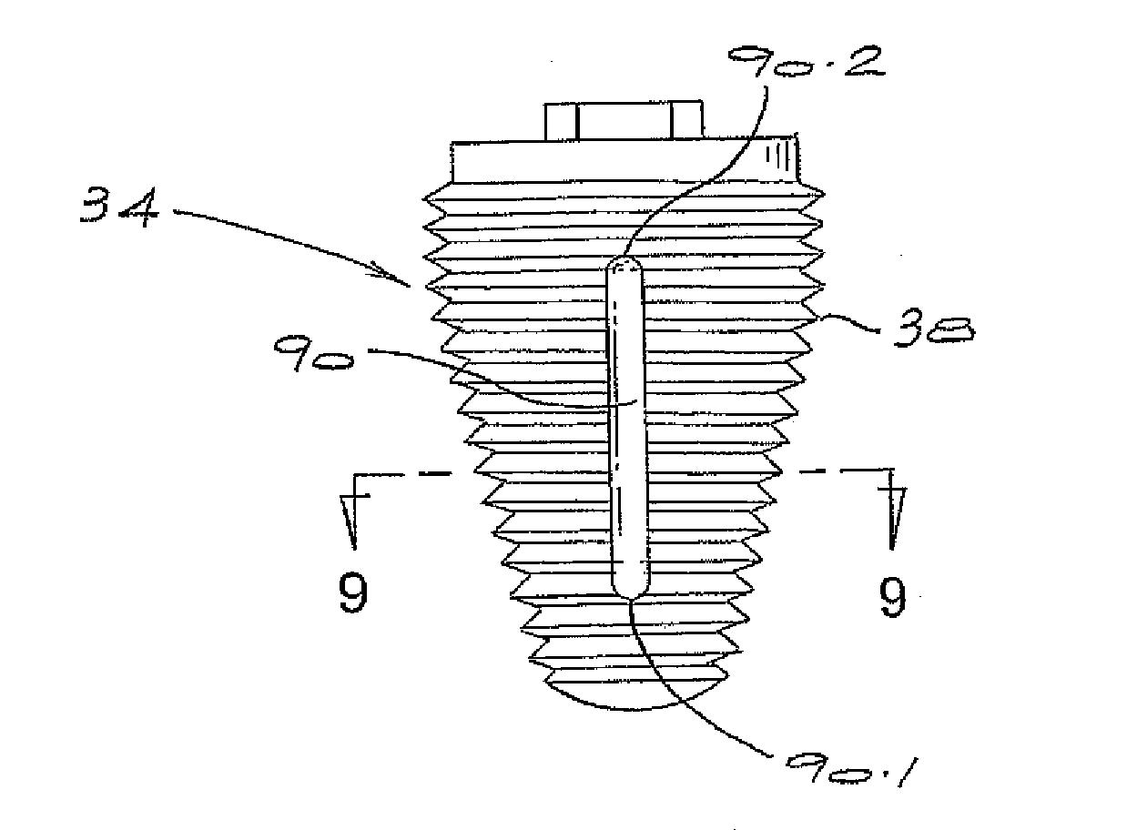 Molar Implant and Method