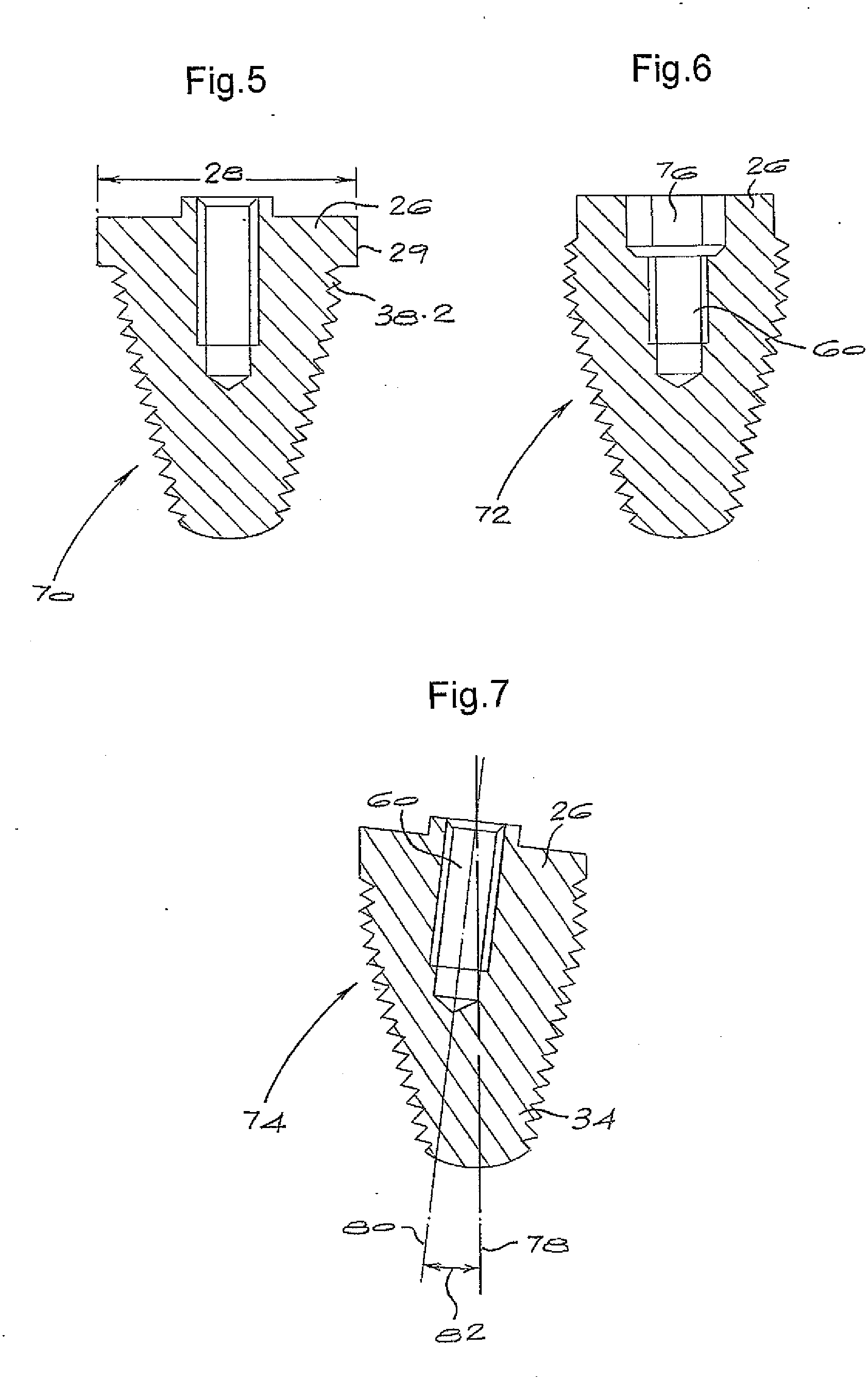 Molar Implant and Method