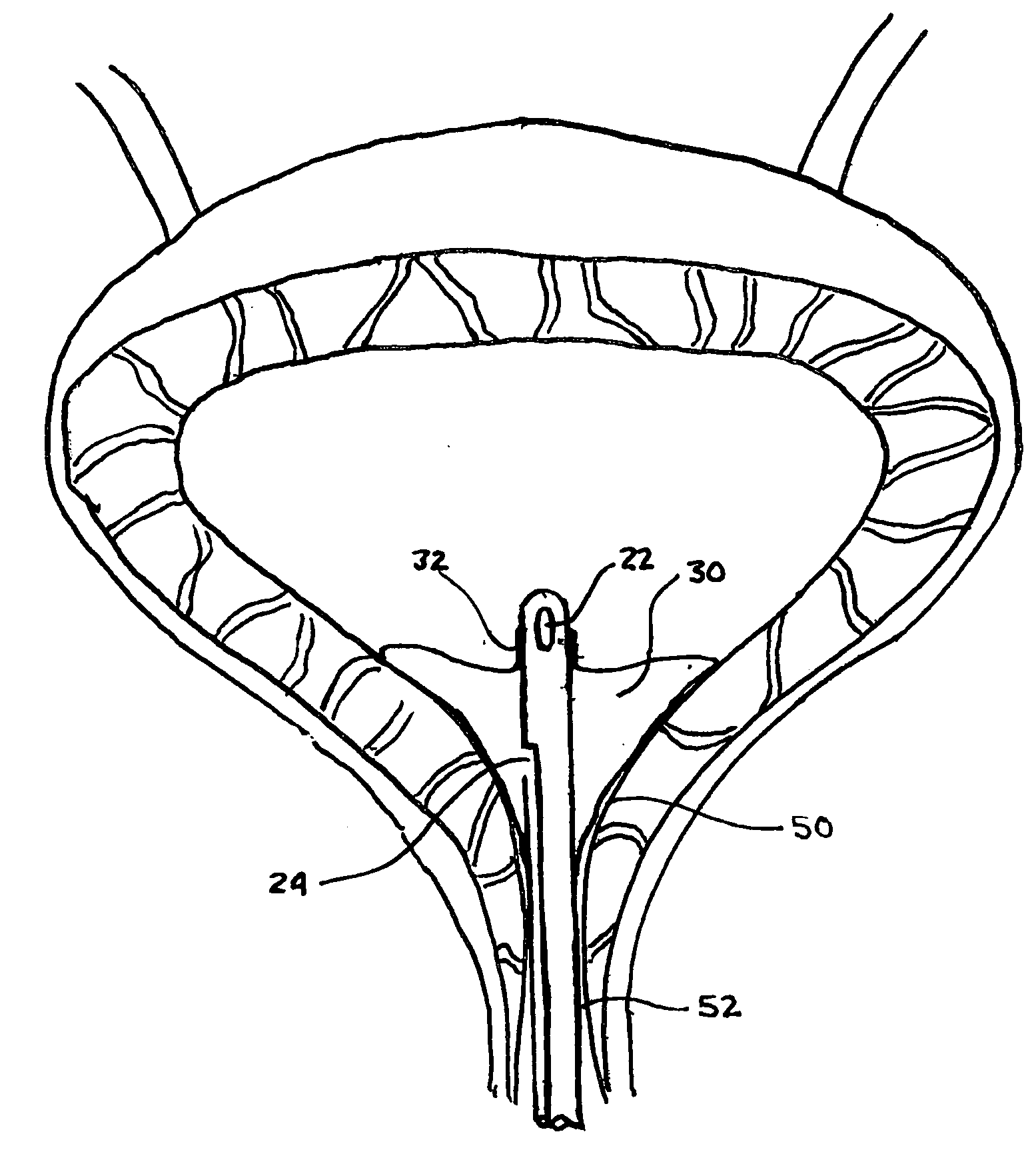 Indwelling urinary catheter with enlarged sealing surface