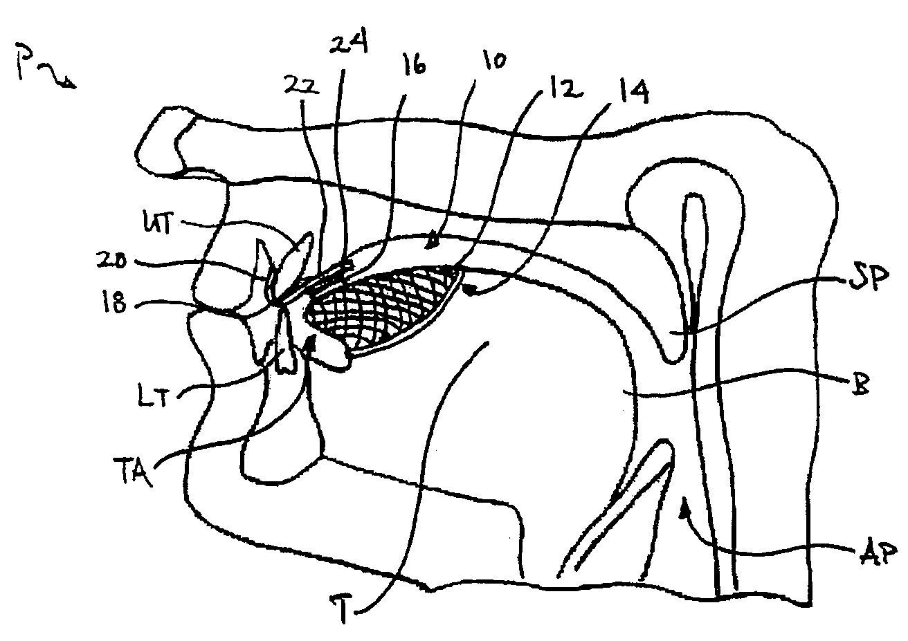 Tongue retention system