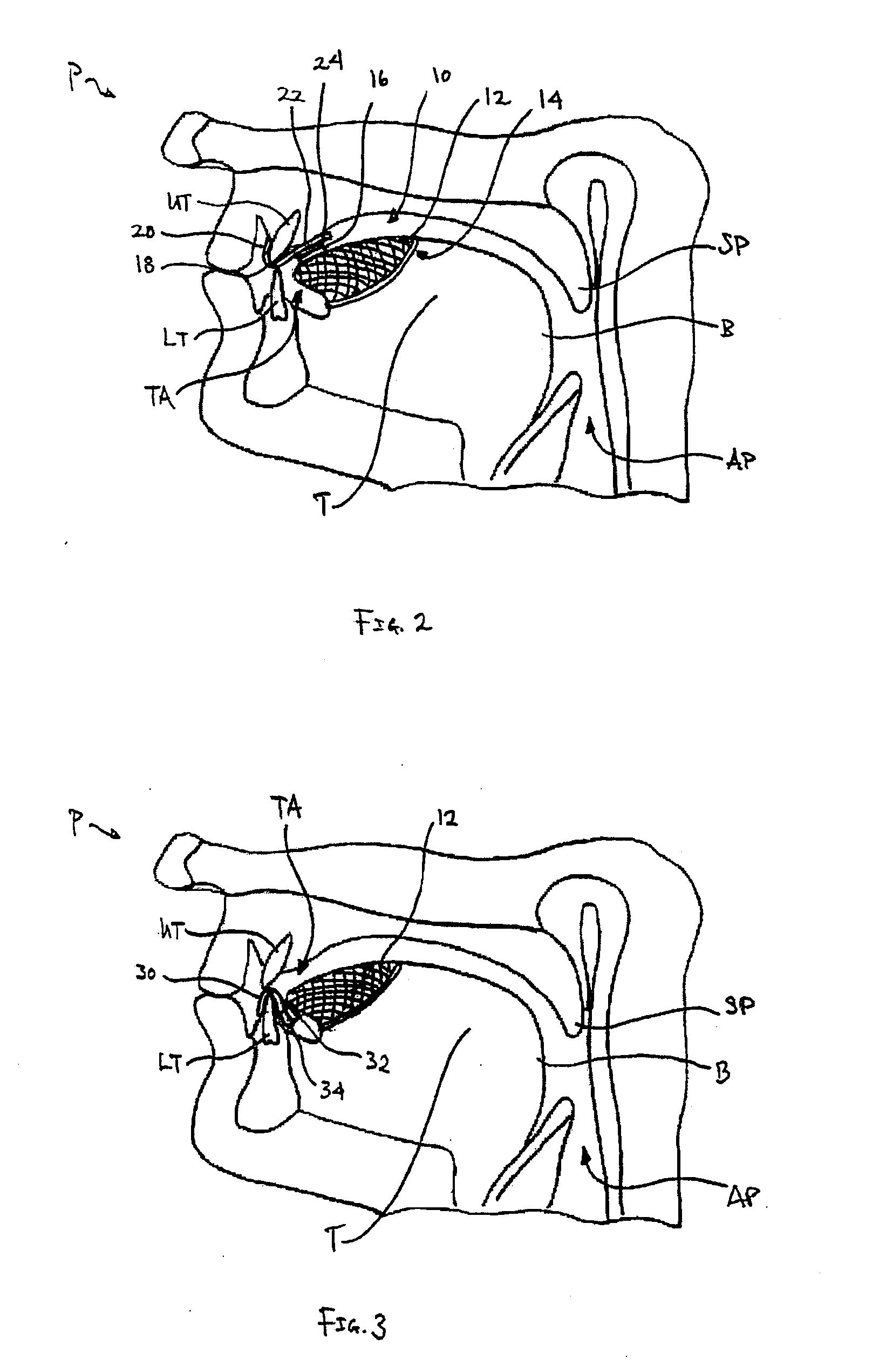 Tongue retention system