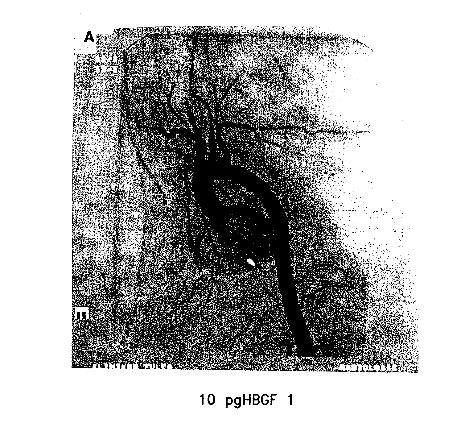 Method of producing biologically active human acidic fibroblast growth factor and its use in promoting angiogenesis