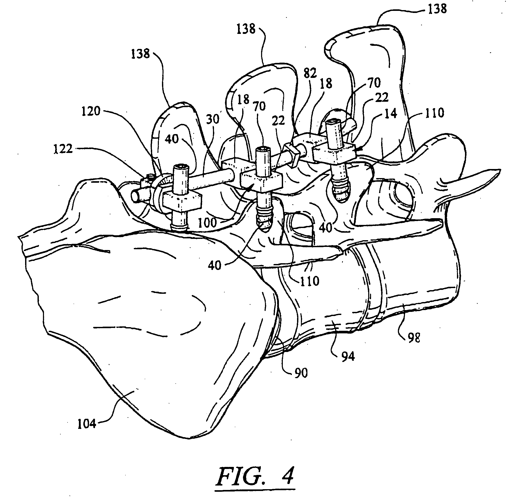 Artificial facet joint and method