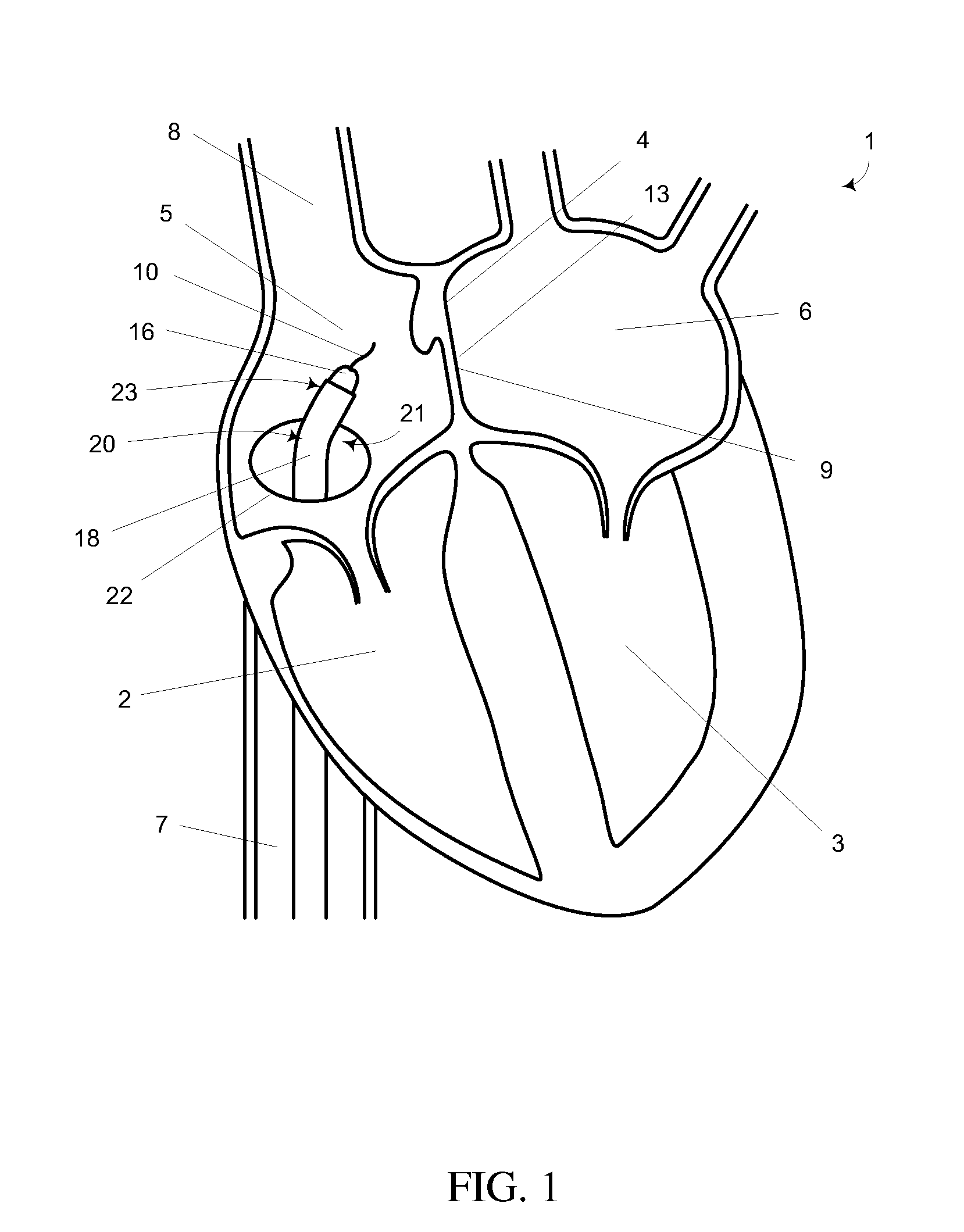 Mitral valve spacer and system and method for implanting the same