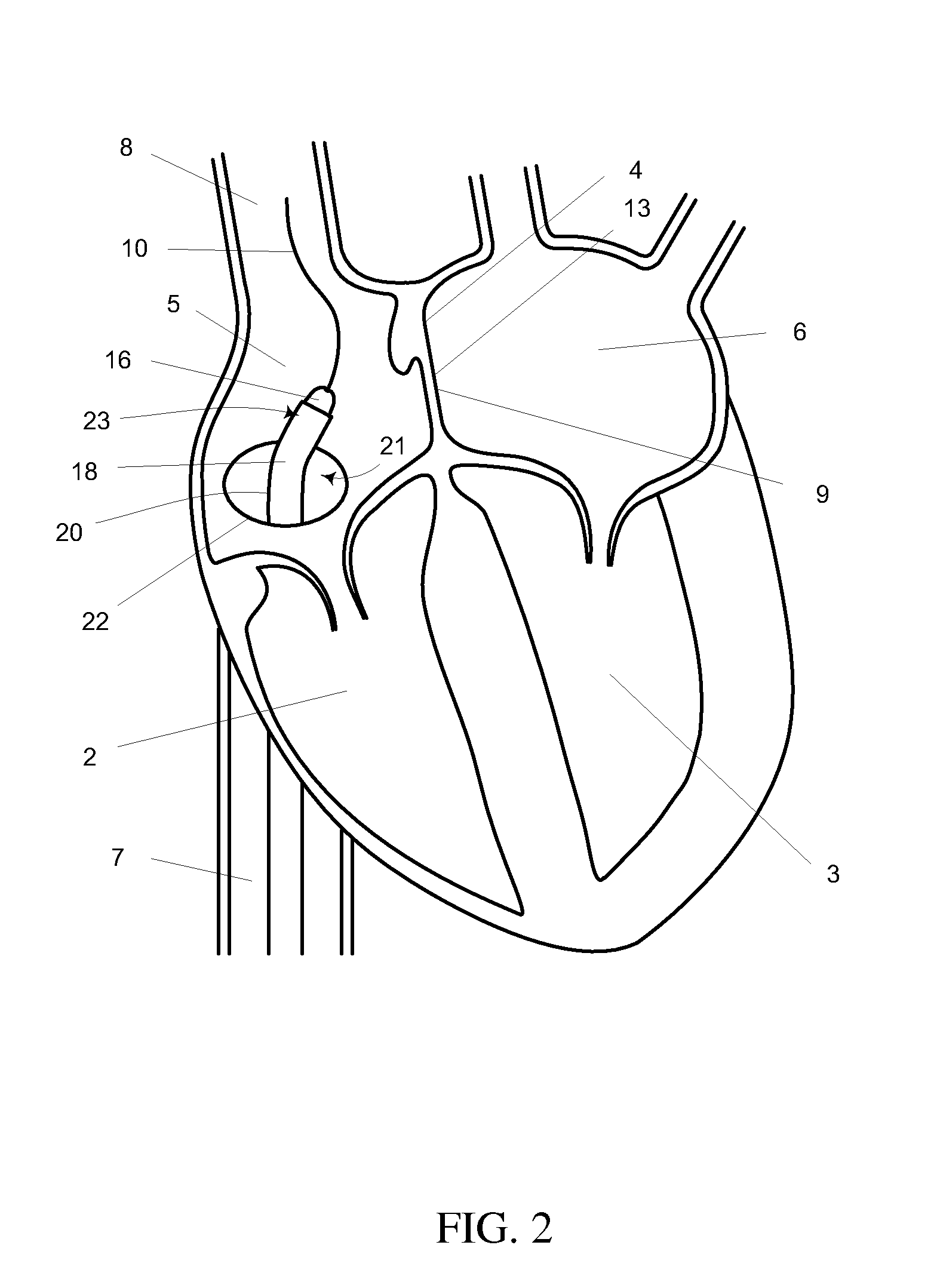 Mitral valve spacer and system and method for implanting the same