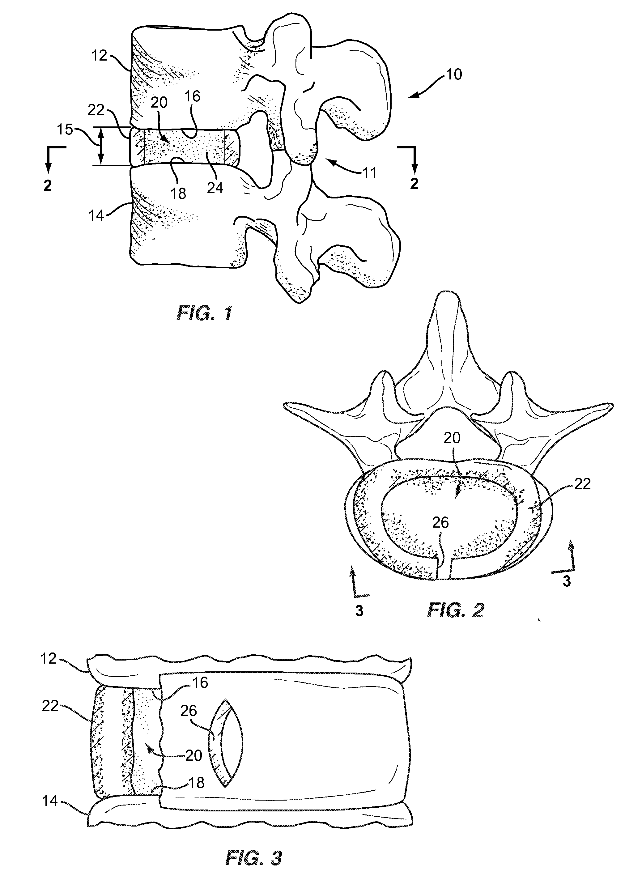 Spinal nucleus replacement implant