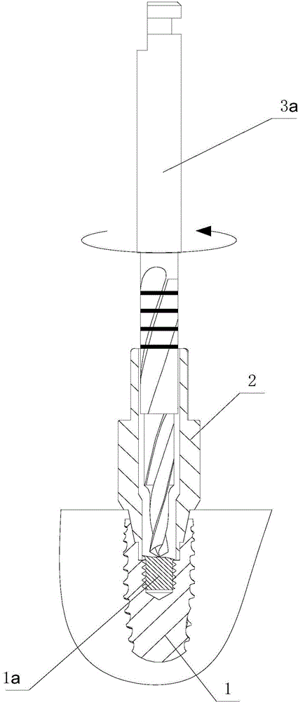 Implant removal tool and removal method