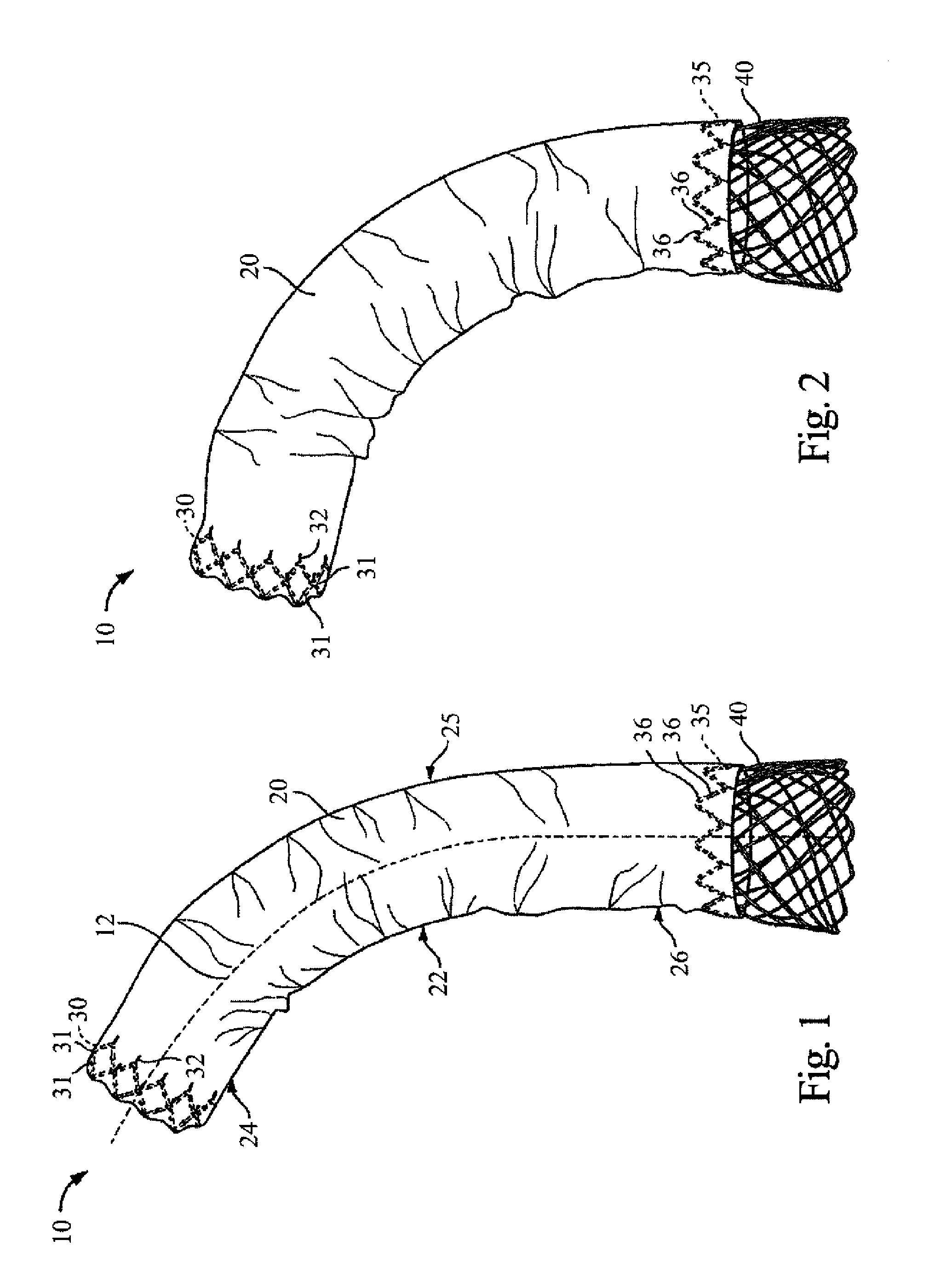 Method for Deployment of a Stent Graft