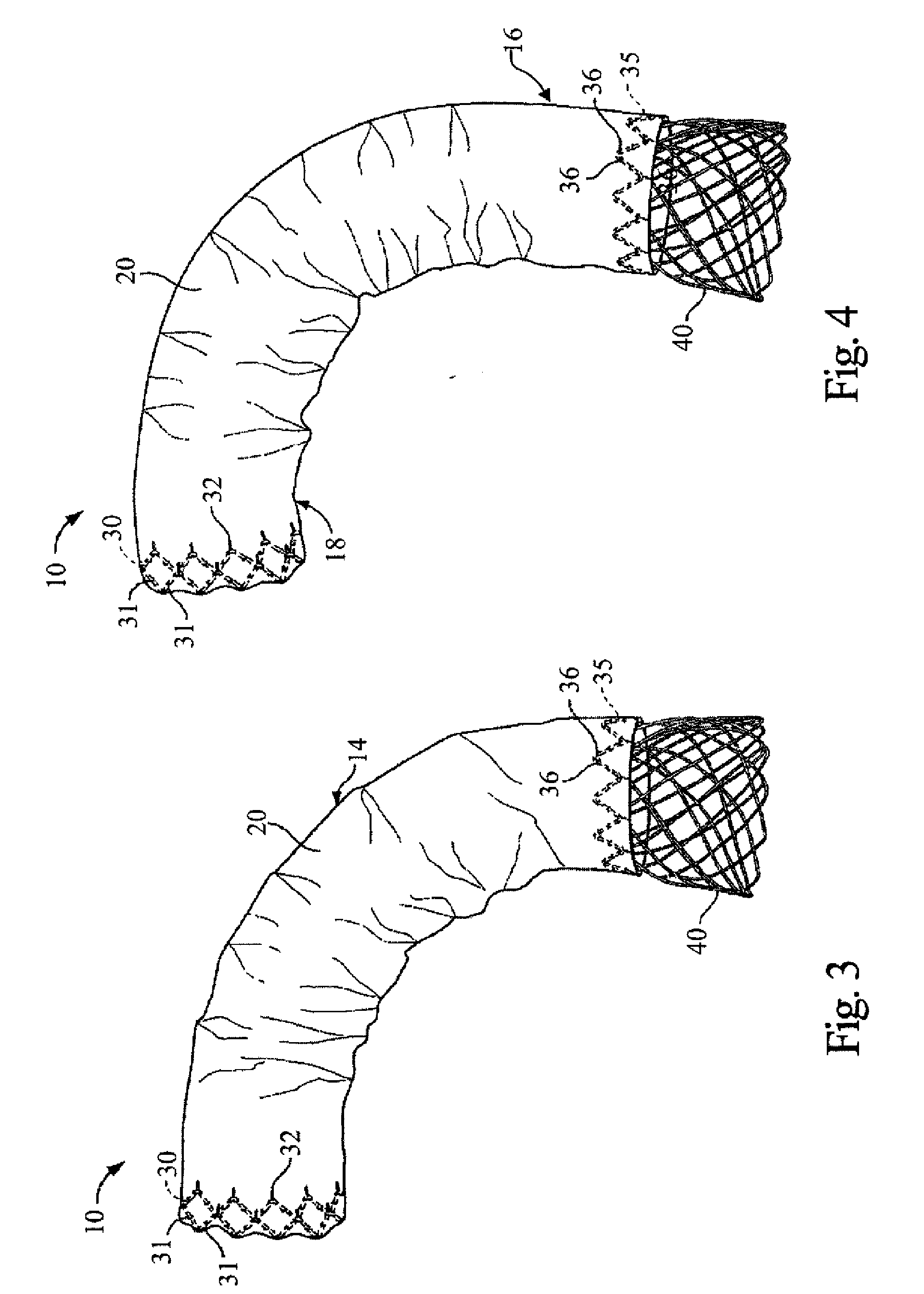 Method for Deployment of a Stent Graft