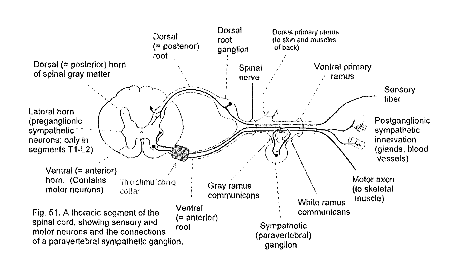 Spinal nerve stimulation rings for rehabilitation of patients with spinal trauma and stroke