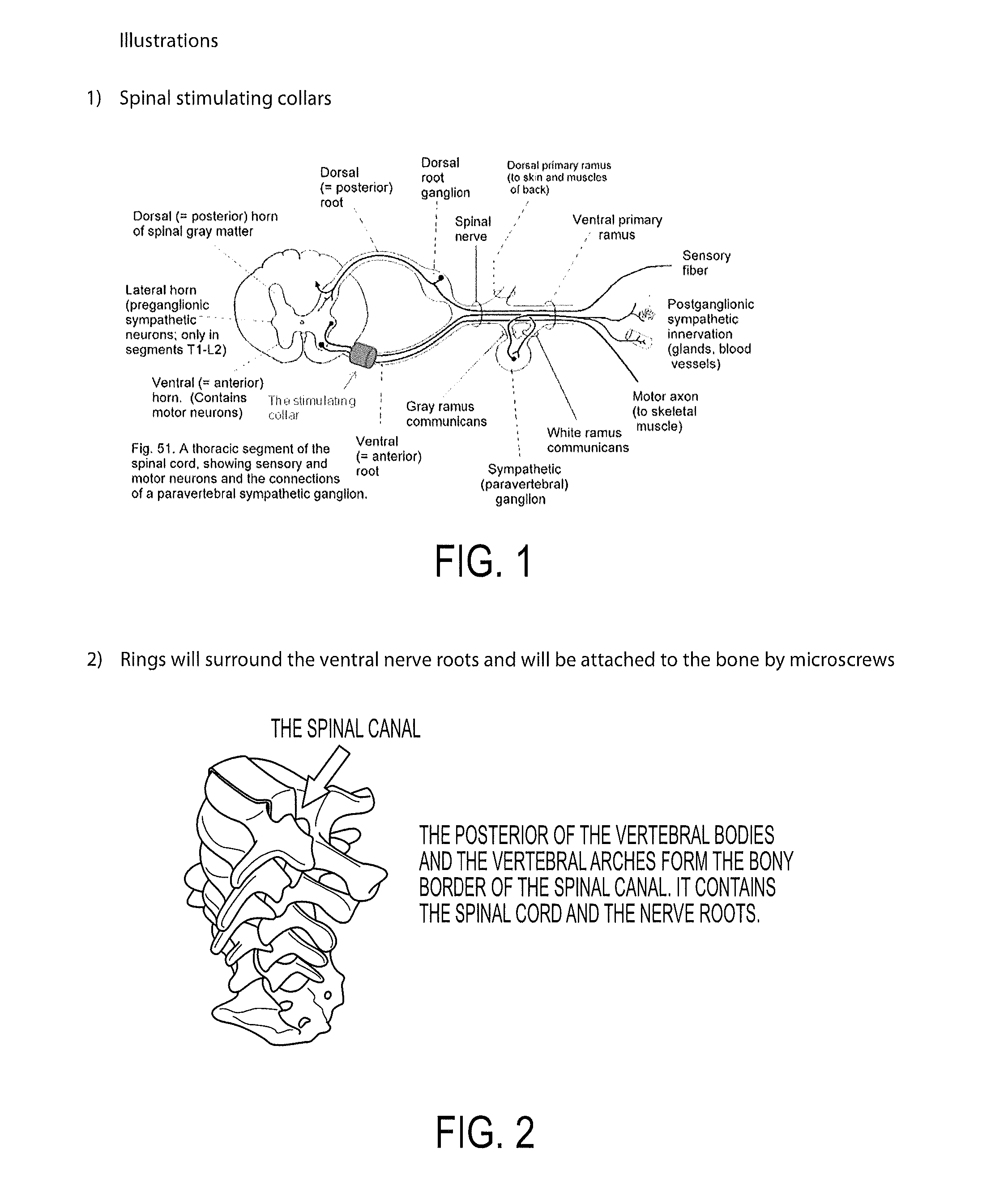 Spinal nerve stimulation rings for rehabilitation of patients with spinal trauma and stroke