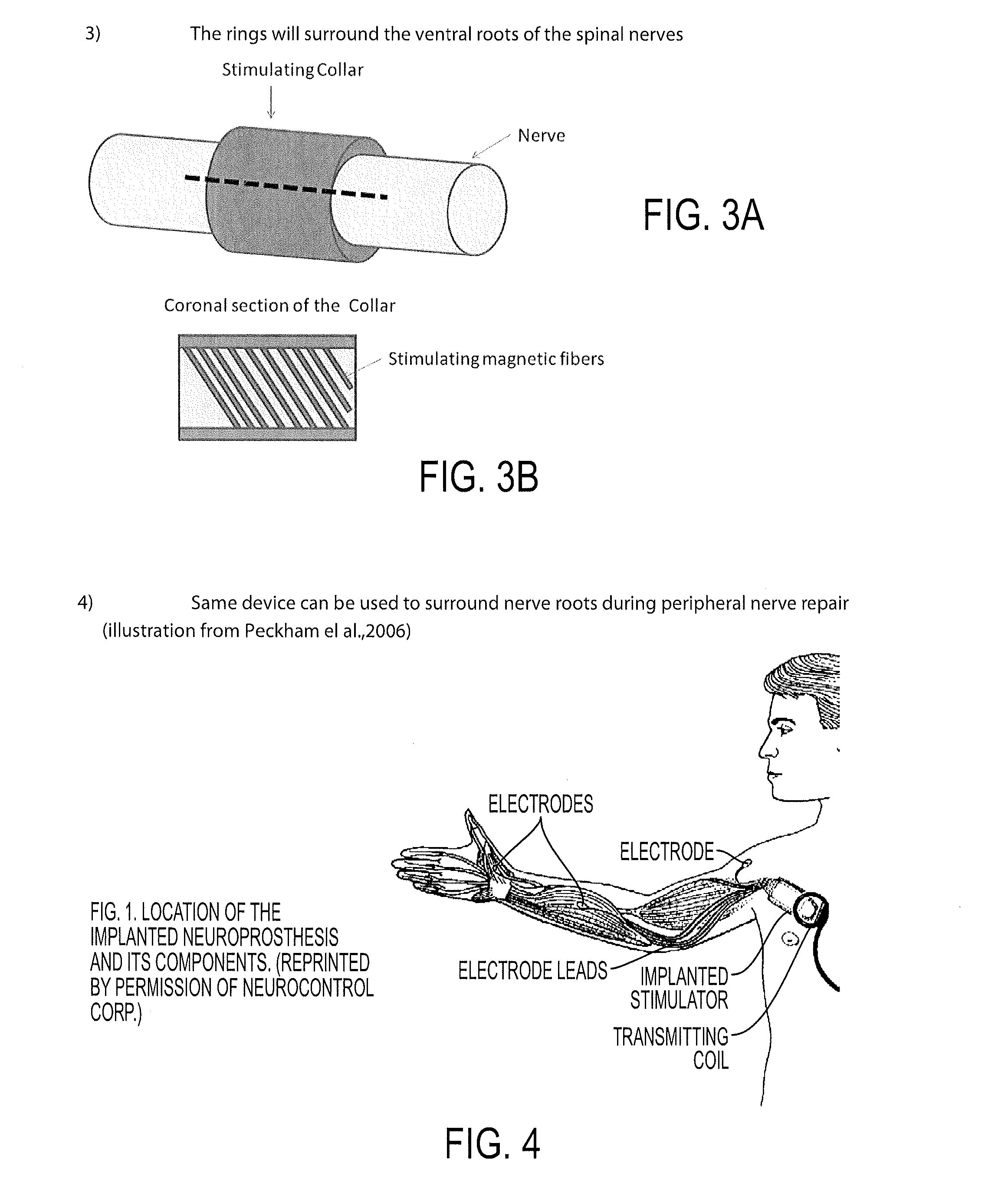 Spinal nerve stimulation rings for rehabilitation of patients with spinal trauma and stroke