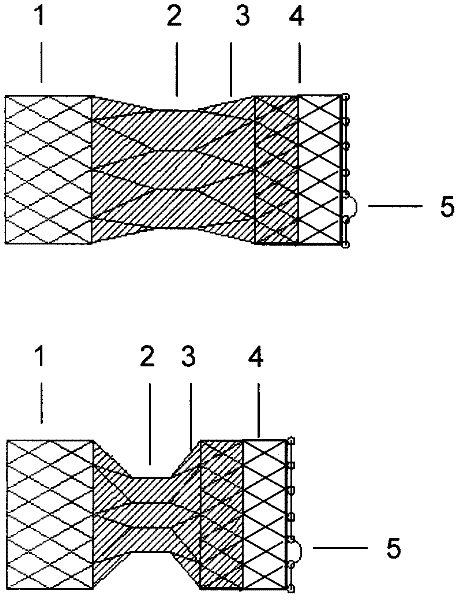 Recyclable and adjustable interventional stent for constricting blood vessels