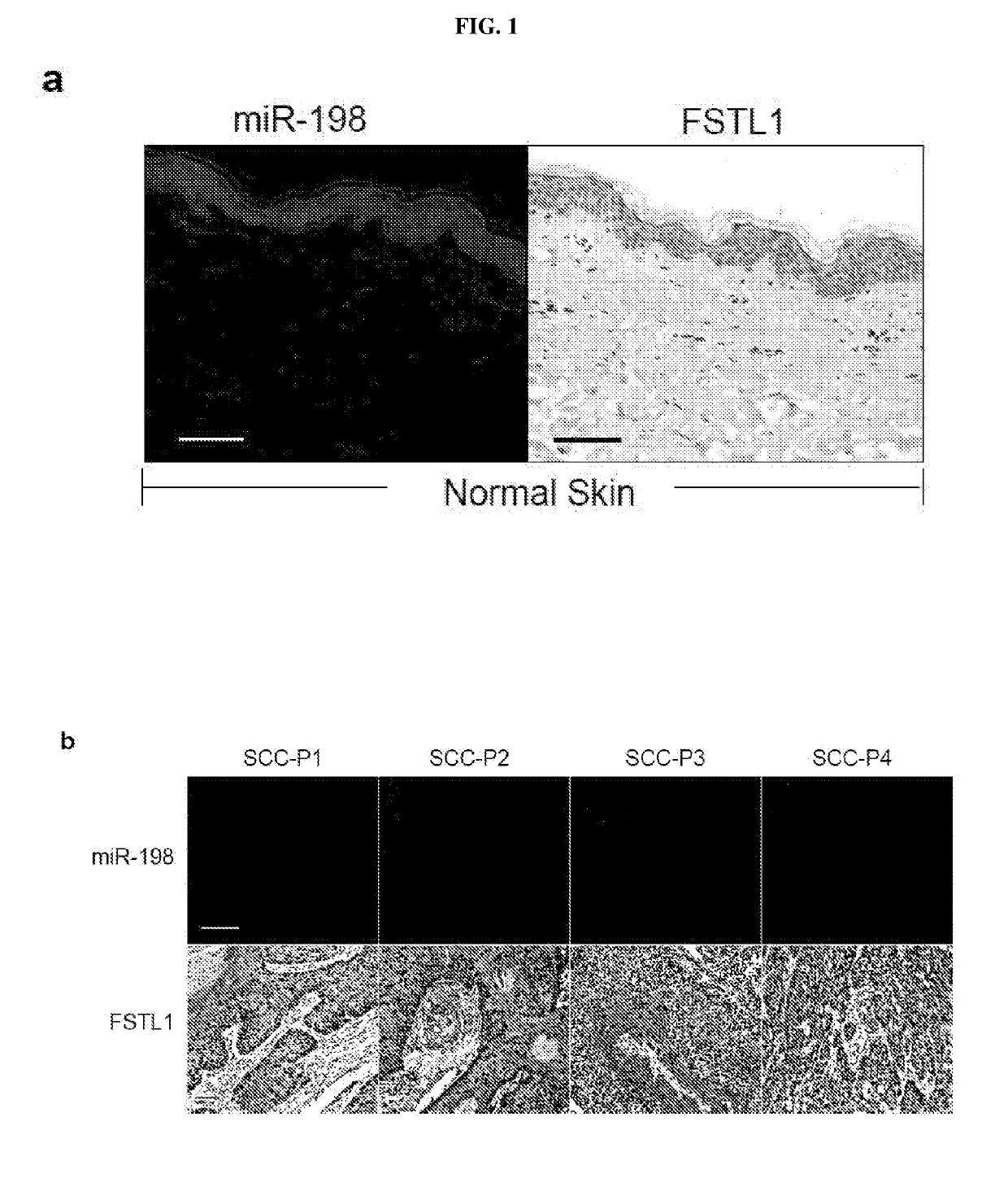 Consequences of a defective switch in cutaneous squamous cell carcinoma