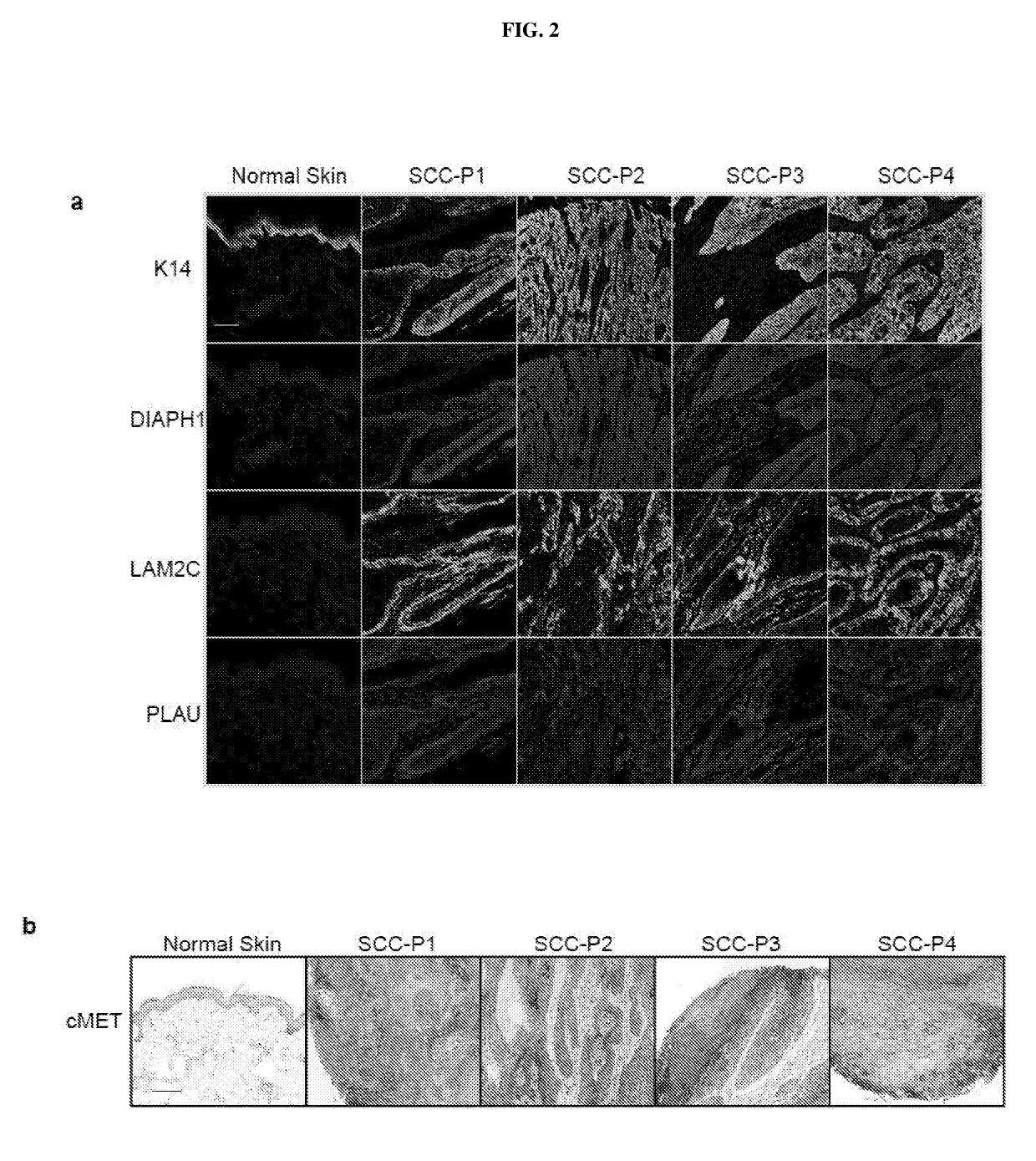 Consequences of a defective switch in cutaneous squamous cell carcinoma