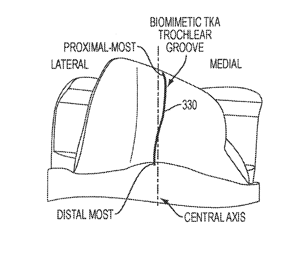 Implant for Restoring Normal Range Flexion and Kinematics of the Knee