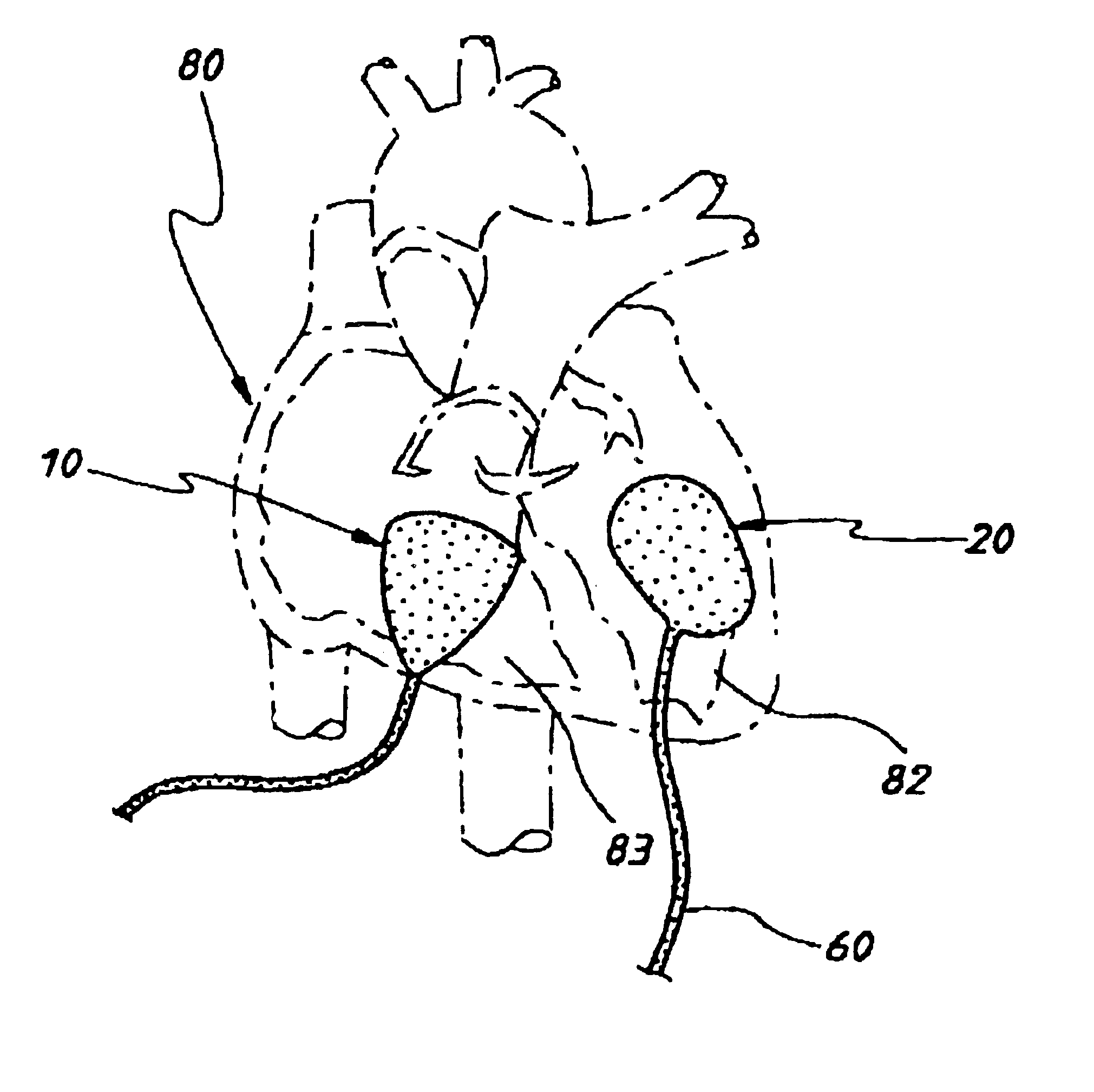 Assist device for the failing heart