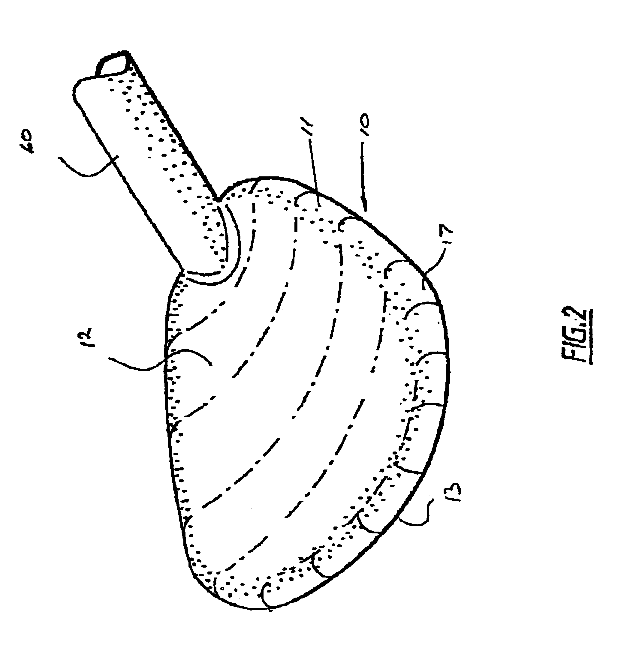 Assist device for the failing heart