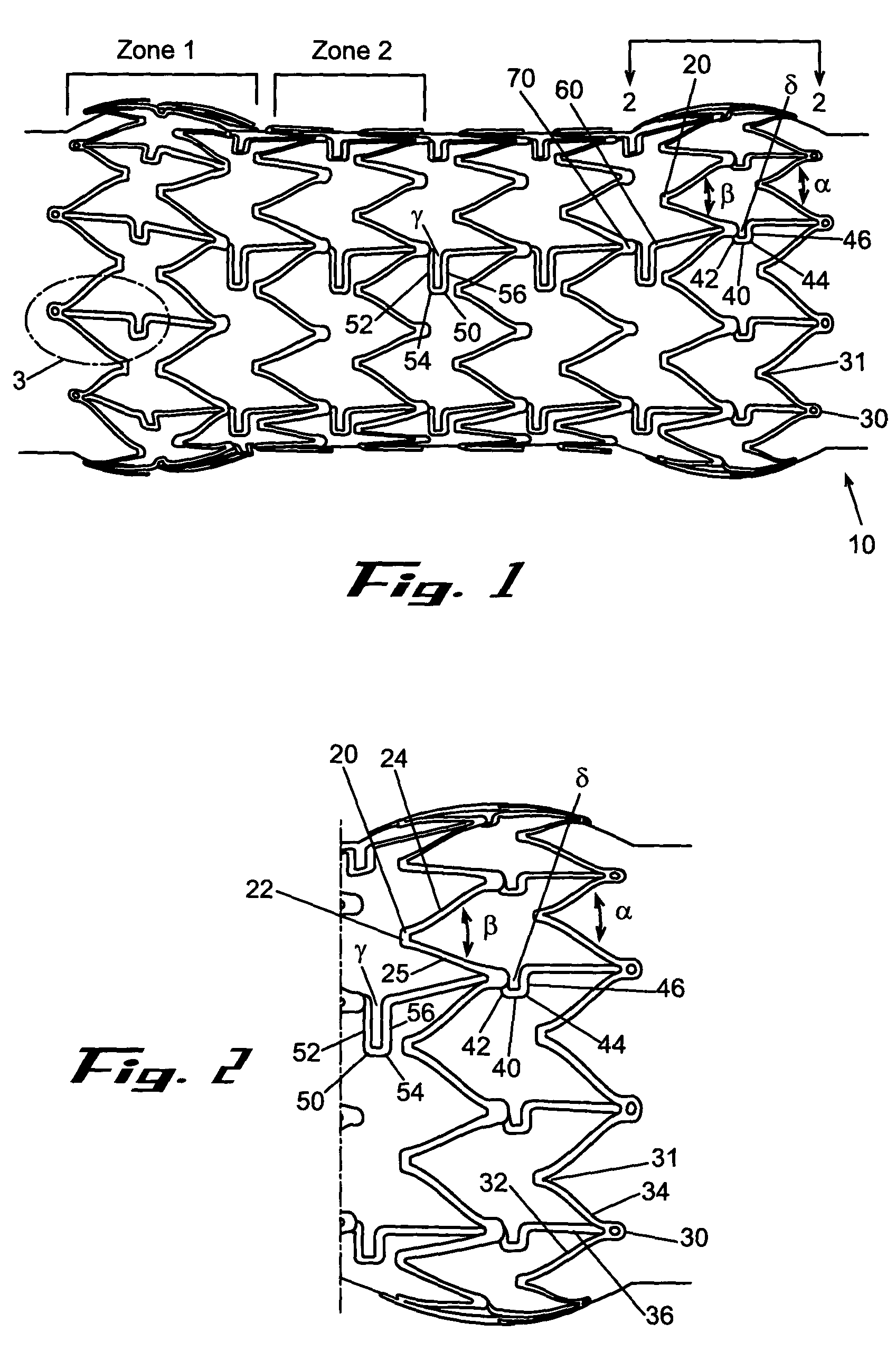 Removable biliary stent