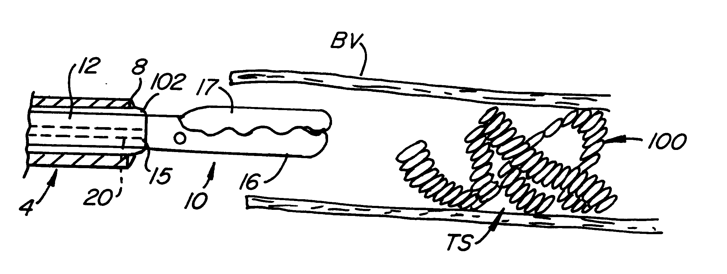 Method and device for enhancing vessel occlusion