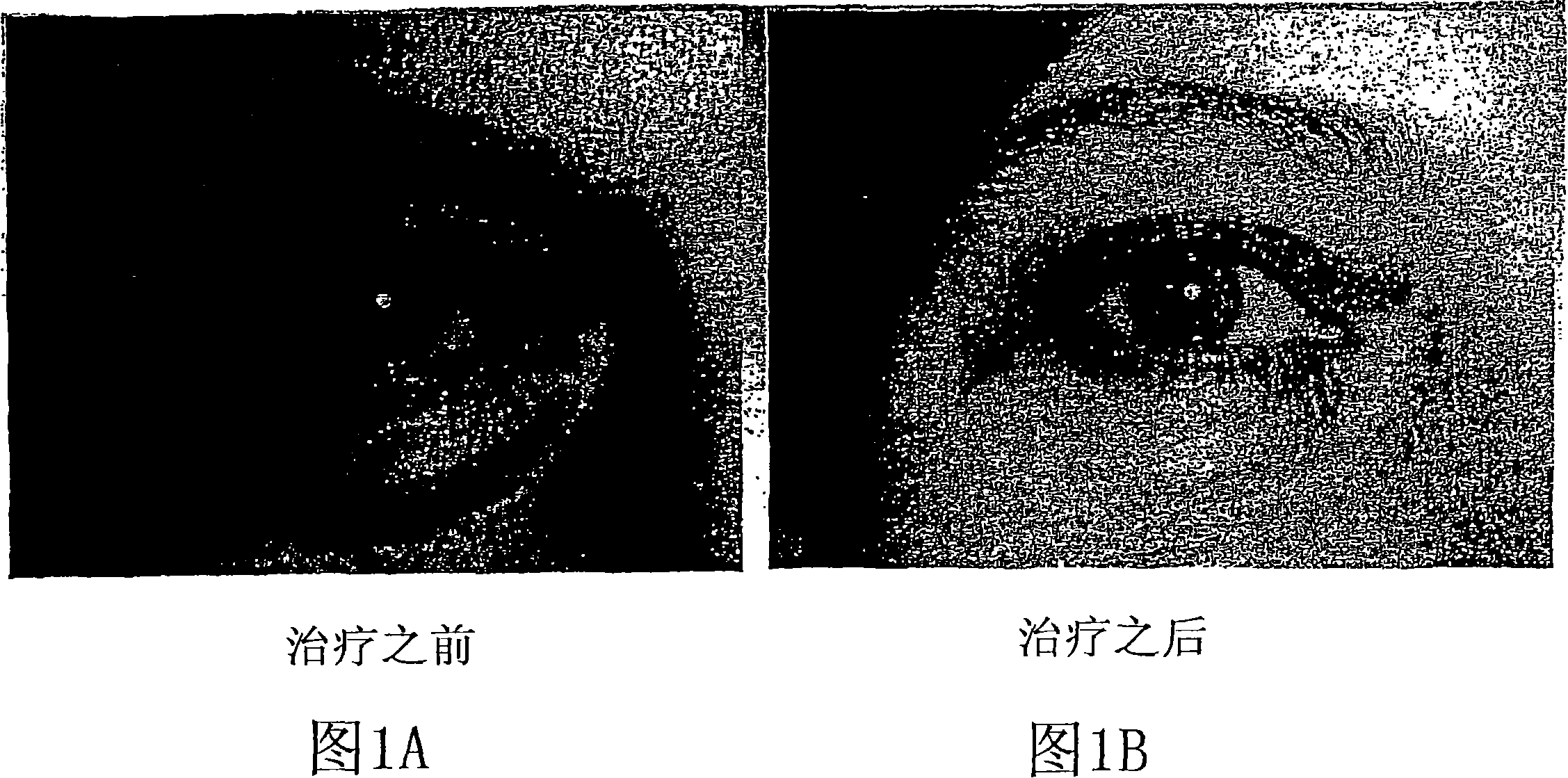 Cosmetic laser treatment device and method for localized lipodystrophies and flaccidity