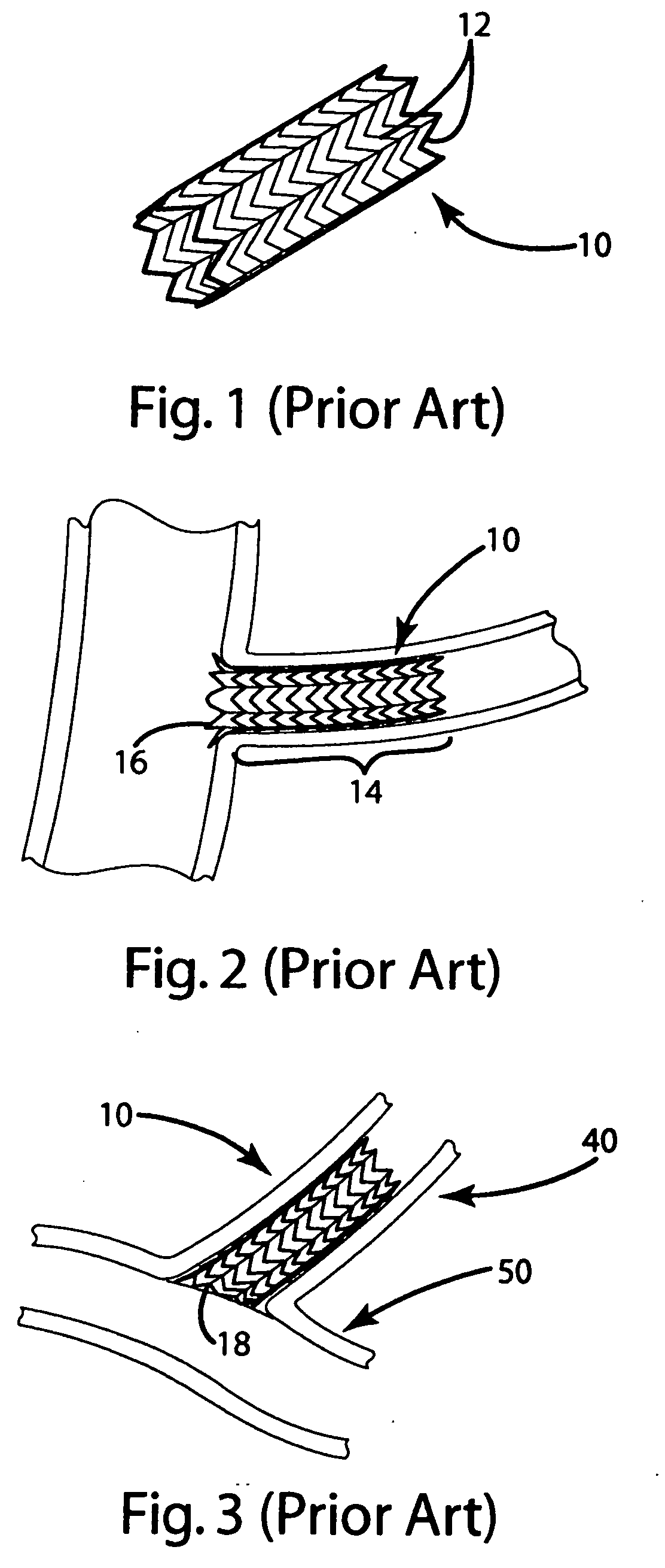 Ostial stent