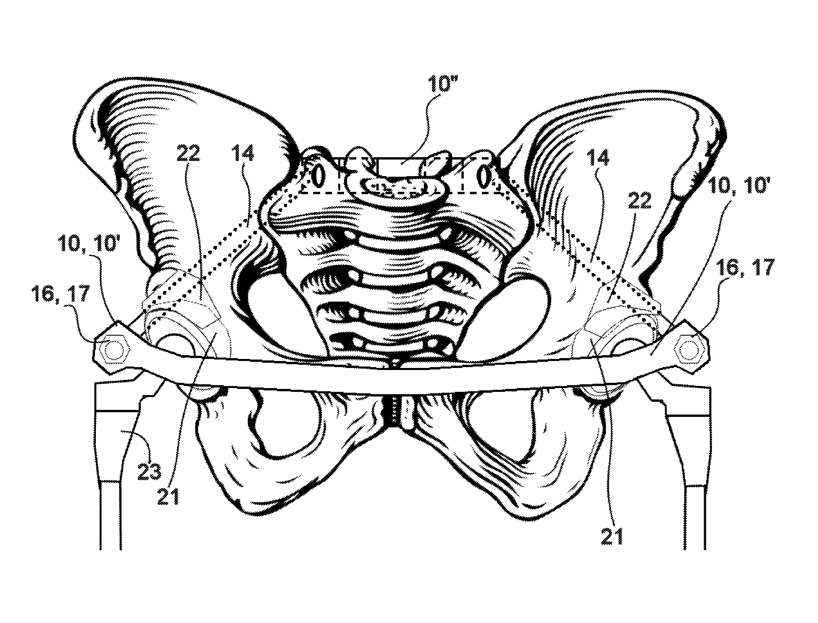 Method and apparatus for minimally invasive treatment of unstable pelvic ring injuries combined with hip arthroplasty