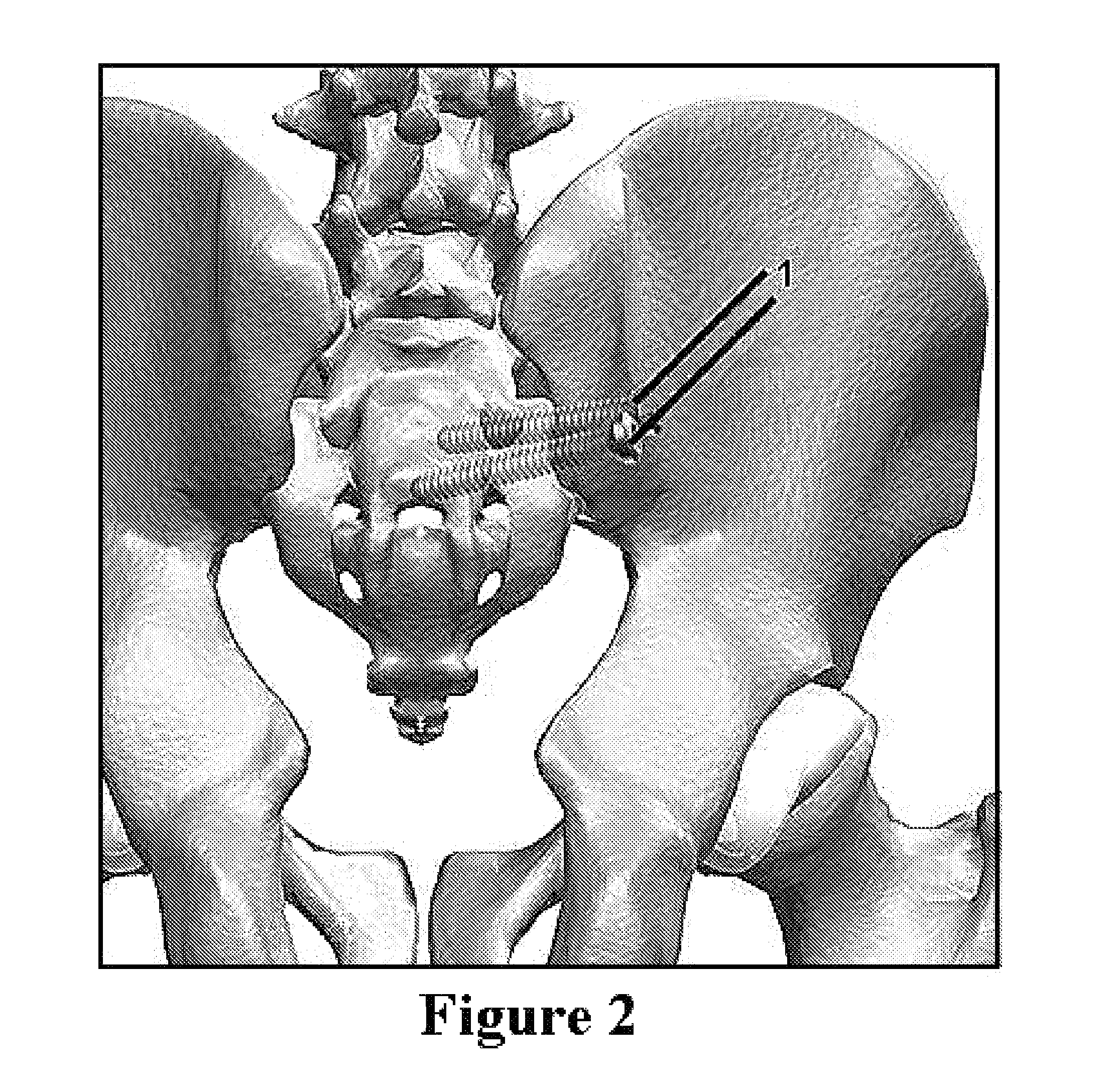 Method and apparatus for minimally invasive treatment of unstable pelvic ring injuries combined with hip arthroplasty