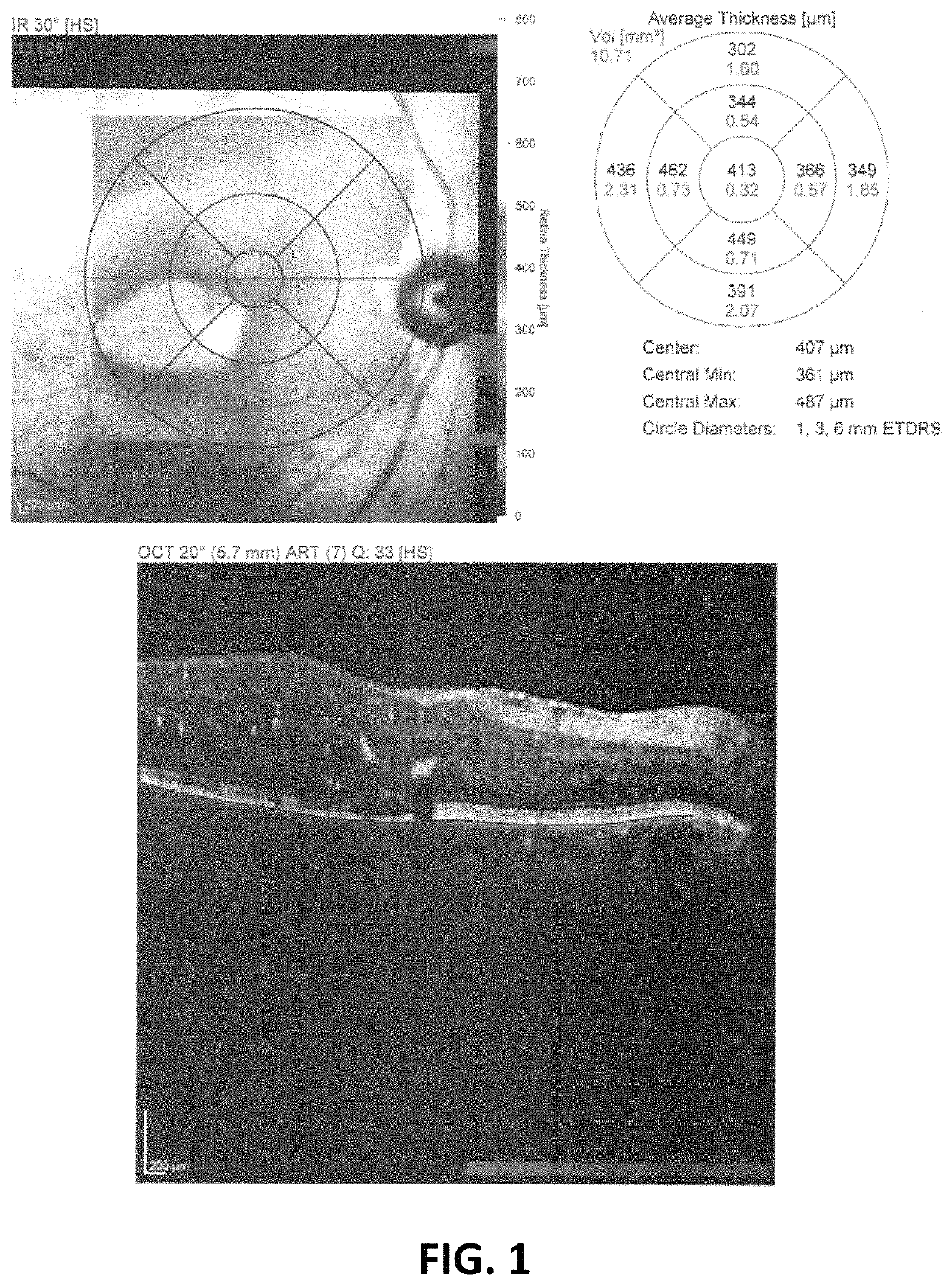 Salbutamol-containing ophthalmic medicament