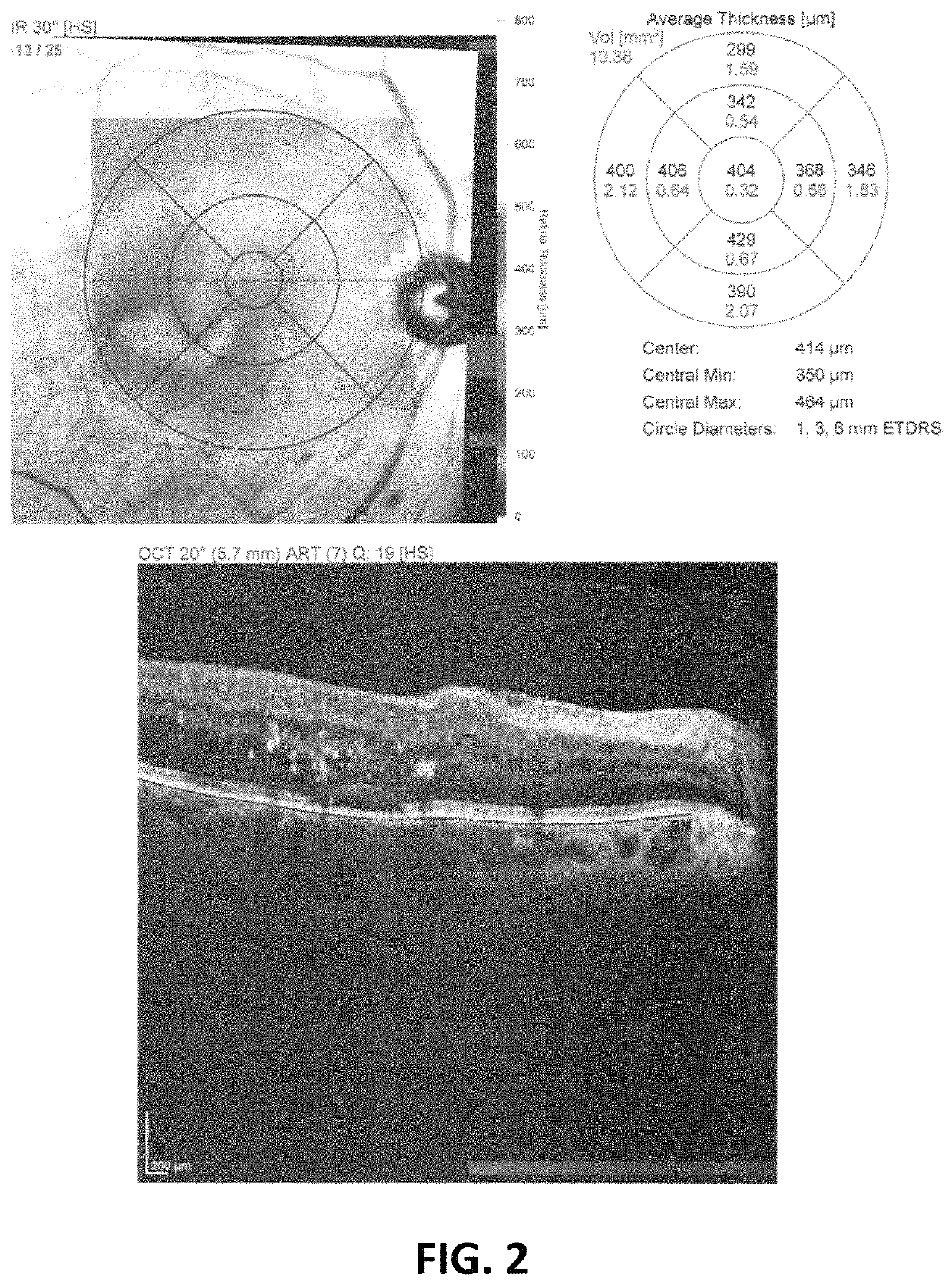 Salbutamol-containing ophthalmic medicament