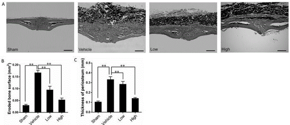 Application of melatonin to preparation of medicine for treating loose periprosthetic chronic inflammation and bone destruction