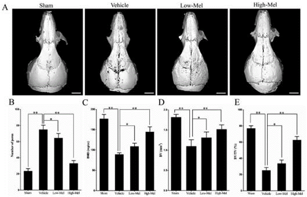 Application of melatonin to preparation of medicine for treating loose periprosthetic chronic inflammation and bone destruction