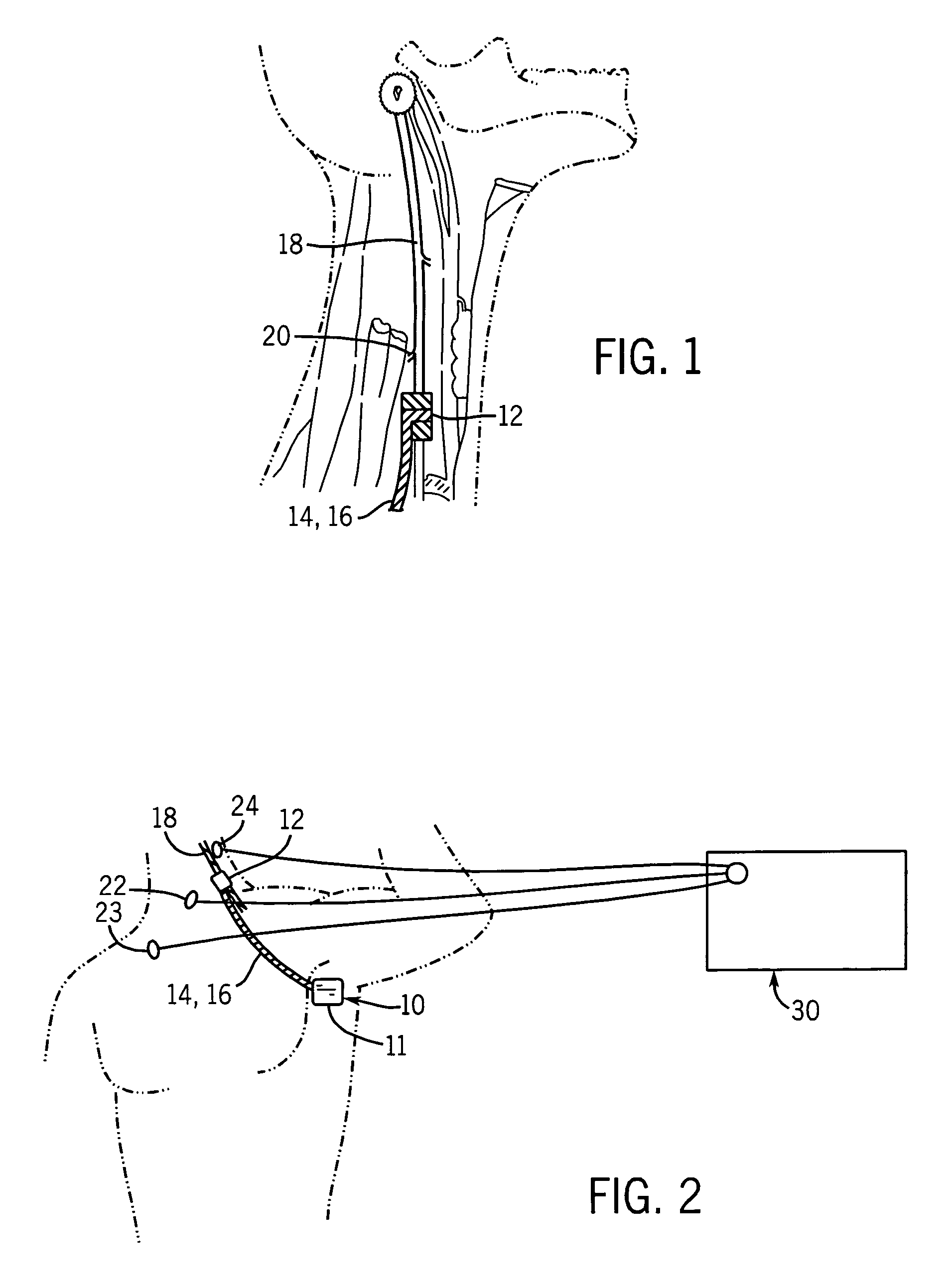 Method and apparatus for detecting vagus nerve stimulation