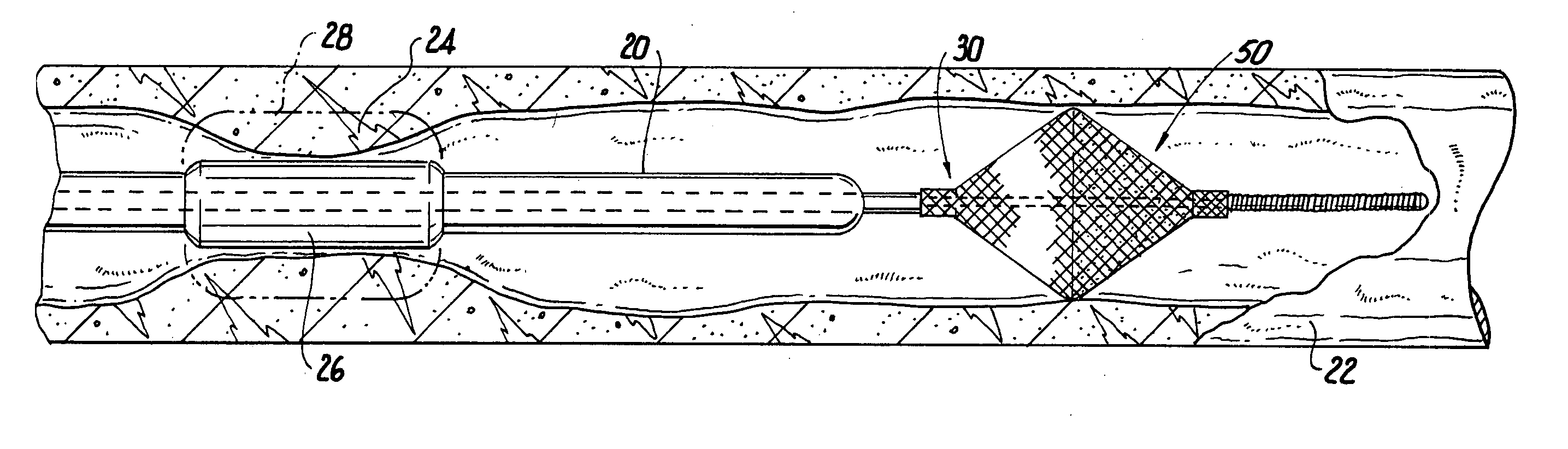 Temporary vascular filter guide wire