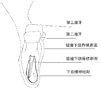 Implant used for artificial dental implant when bone mass of alveolar bone is insufficient